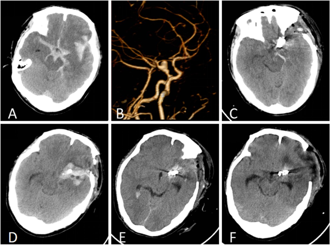 Five CT scan images labeled A, C, D, E, F, show various brain sections, highlighting different densities and structures. Image B is a detailed 3D rendering of cerebral blood vessels, displaying intricate arterial pathways.