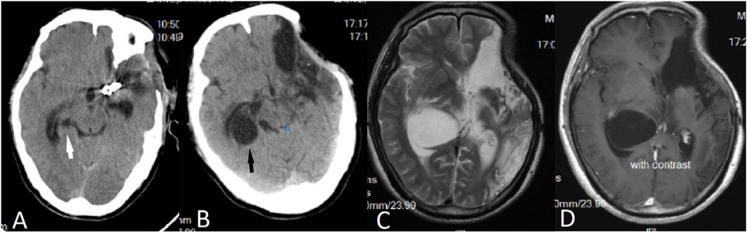 Four-panel medical imaging showing brain scans labeled A to D. Panels A and B are CT scans with arrows indicating areas of interest. Panels C and D are MRI scans, with D labeled “with contrast,” highlighting different tissues and structures in the brain.