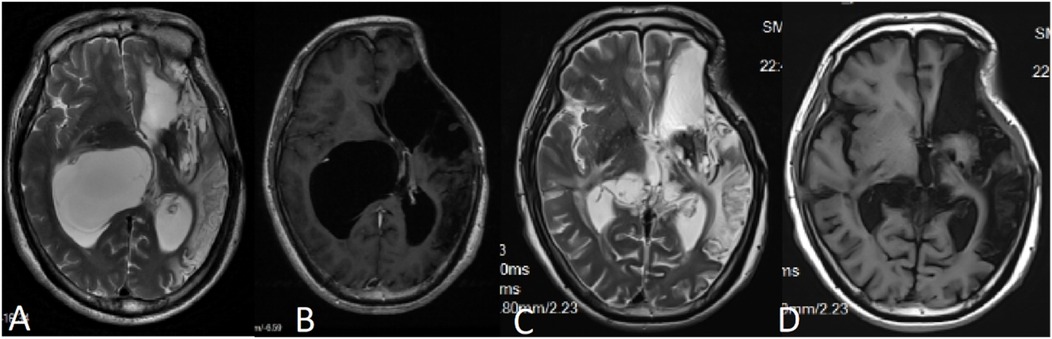 Four MRI brain scans labeled A, B, C, and D show different cross-sectional views. Each image displays varying intensity and structural characteristics, highlighting areas of difference within the brain's tissues.