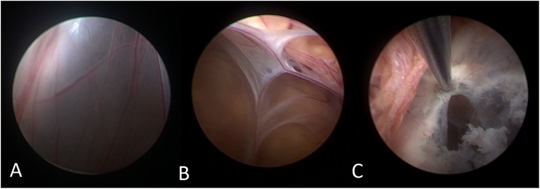 Three circular images labeled A, B, and C show different stages of an endoscopic procedure. Image A shows a smooth surface with visible blood vessels. Image B shows a close-up of tissue layers. Image C shows a tool interacting with tissue, creating an opening.
