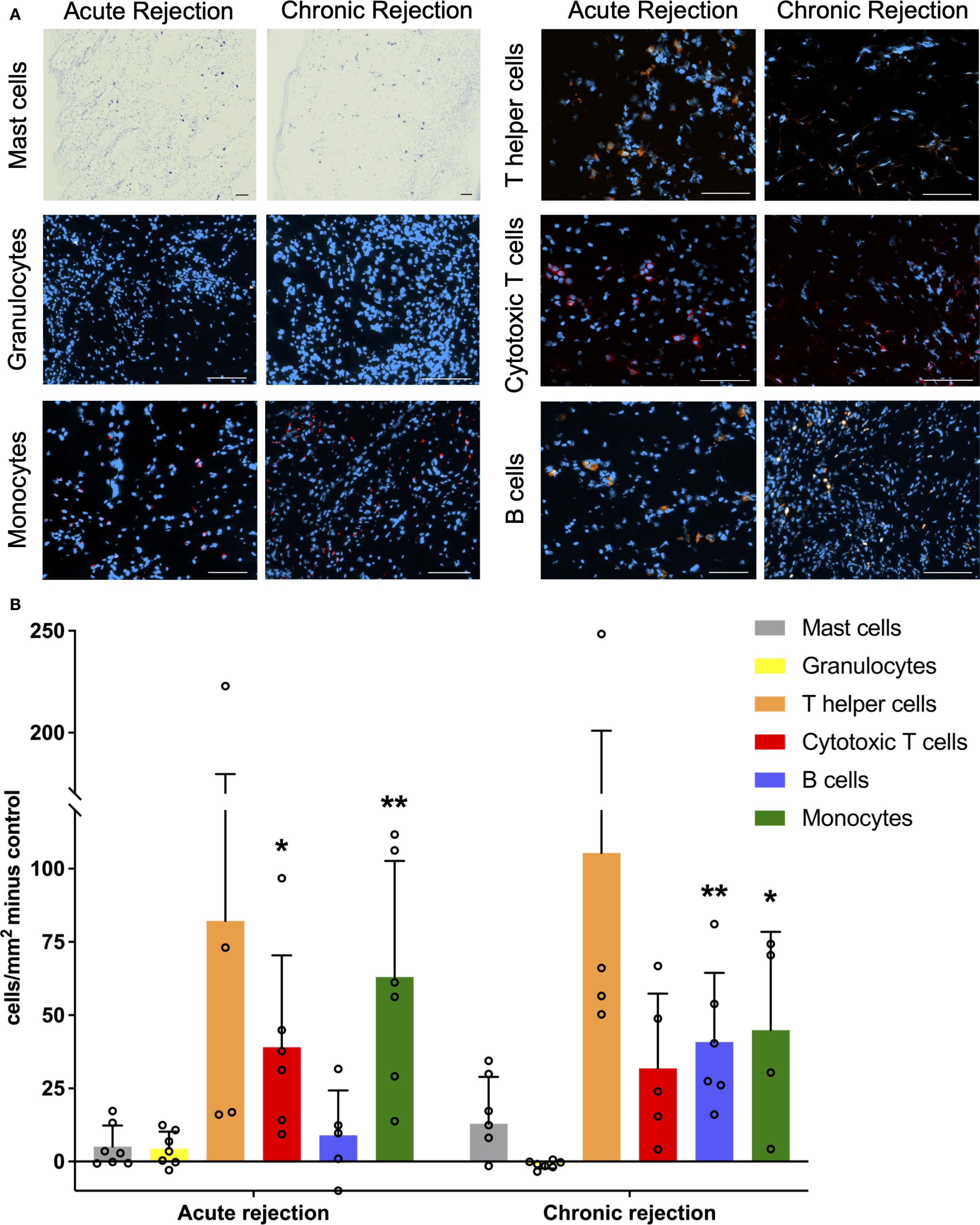 Panel A shows microscopic images comparing immune cell types in acute and chronic rejection, including mast cells, granulocytes, monocytes, T helper cells, cytotoxic T cells, and B cells. Panel B is a bar graph depicting the distribution of these cells per square millimeter minus the control, with color-coded bars for each cell type. Statistical significance is indicated by asterisks.