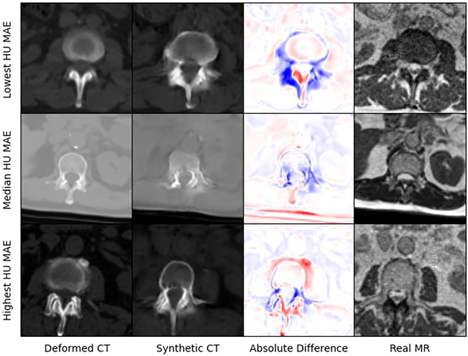 Comparison of spinal imaging across three rows labeled by different HU MAE levels: lowest, median, and highest. Each row contains four images under headings: Deformed CT, Synthetic CT, Absolute Difference, and Real MR. The Absolute Difference column shows red and blue contrast highlighting variations.