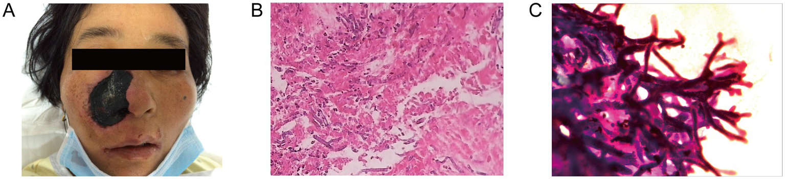 A composite image labeled A, B, and C. Panel A shows a patient with a large black necrotic lesion on the nose. Panel B displays a micrograph of a tissue section with pink and purple staining, indicating tissue changes. Panel C shows a high-magnification micrograph of fungal hyphae stained dark against a lighter background.