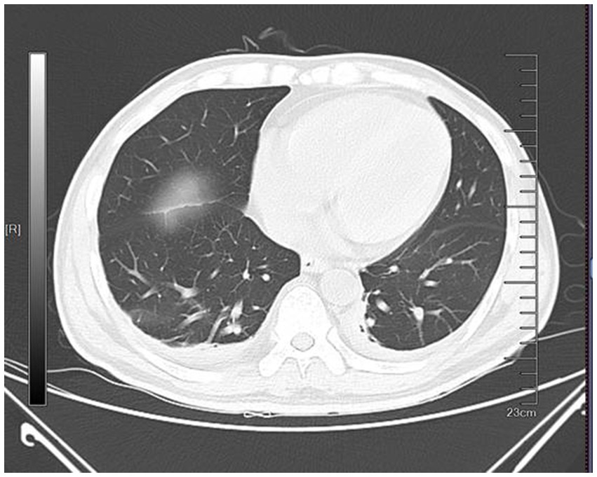 CT scan of the chest showing a cross-sectional view of the lungs and heart. A bright, opaque area is visible in the left lung, indicating a potential abnormality. Rulers on the sides measure dimensions in centimeters.