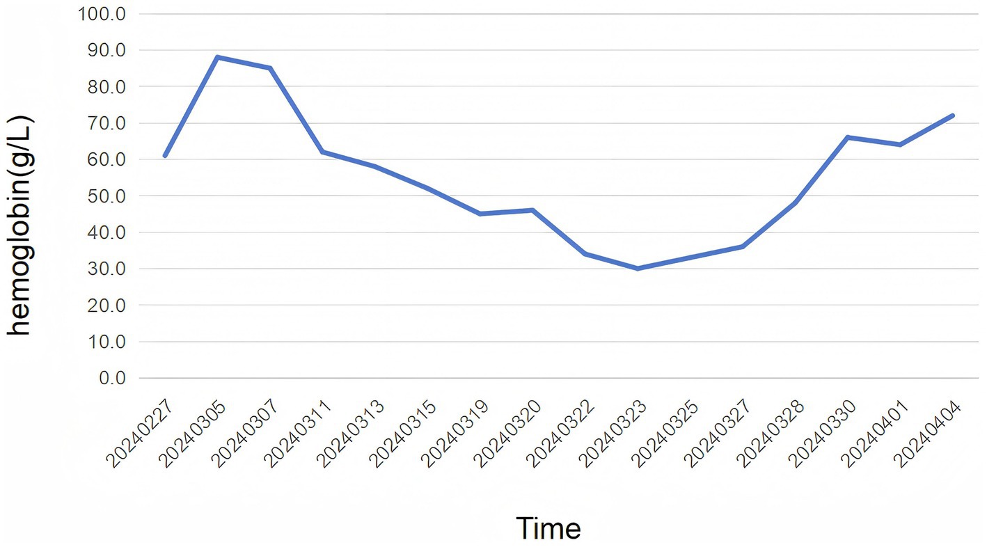 Line graph showing hemoglobin levels in grams per liter over time from February 27, 2024, to April 4, 2024. Levels peak around March 7 at approximately 90 g/L, then decline to a low near March 23 at 55 g/L, followed by a gradual increase, ending above 70 g/L.