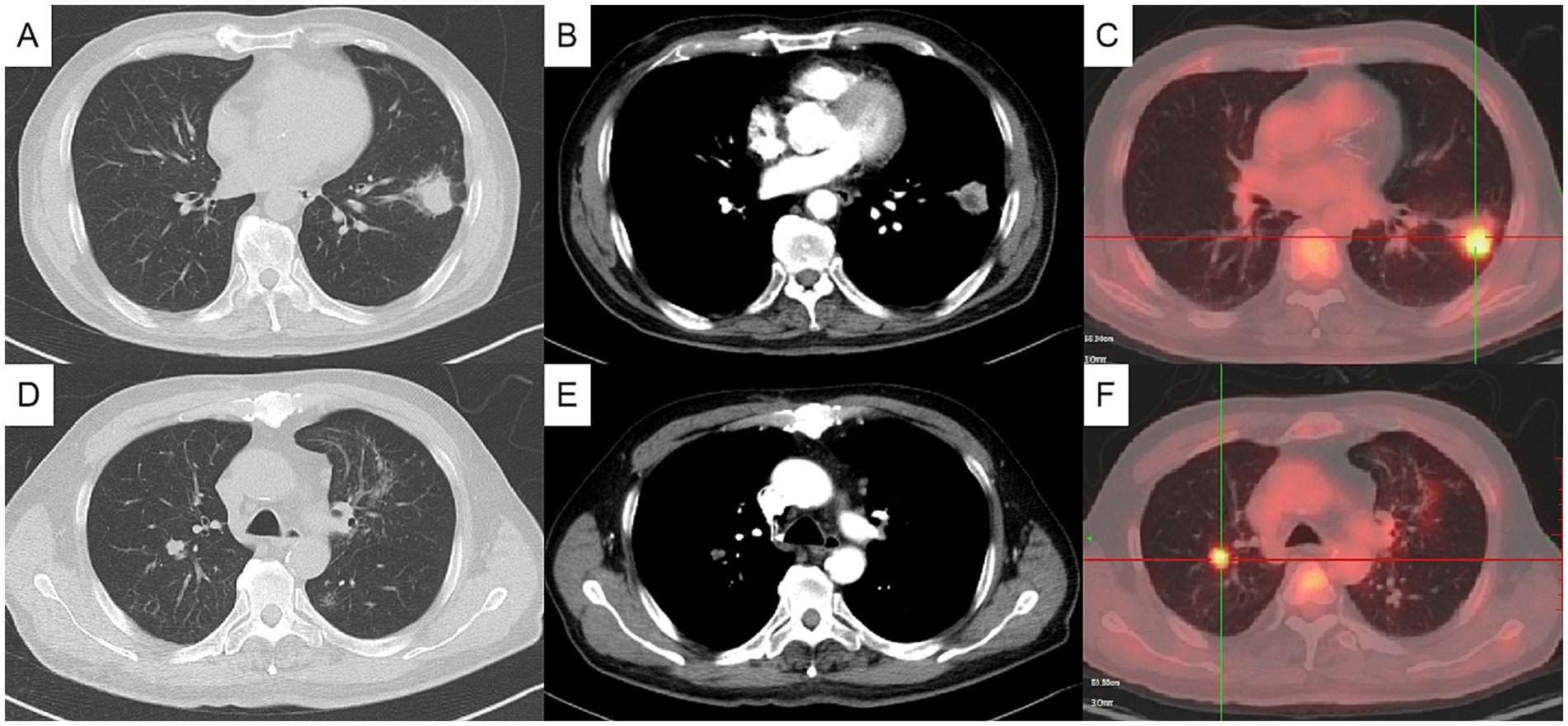 CT and PET scan images of a chest showing a series of slices labeled A to F. Panels A and D depict CT slices of lung tissue with distinct areas that could indicate abnormalities. Figures B and E mainly show the CT images of the mediastinal tissue that could indicate abnormalities. Panels C and F are PET scans with color highlights, where red areas suggest increased metabolic activity, possibly indicating abnormal growths.