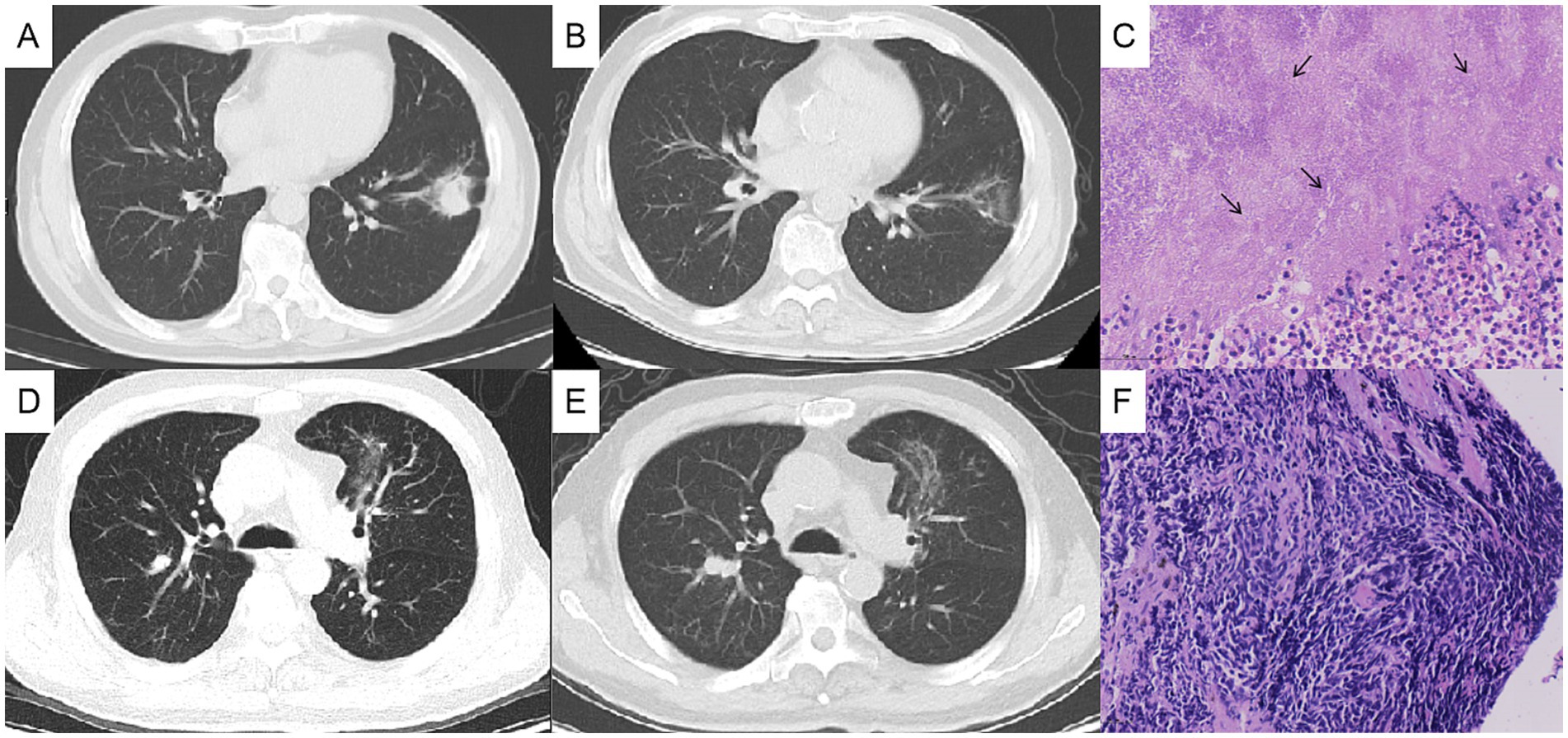 CT scans of lungs in panels A, B, D, and E show variations in tissue density and structure. Histopathology images in panels C and F display tissue samples with cellular details and dark-staining nuclei. Arrows in panel C highlight specific areas of interest.