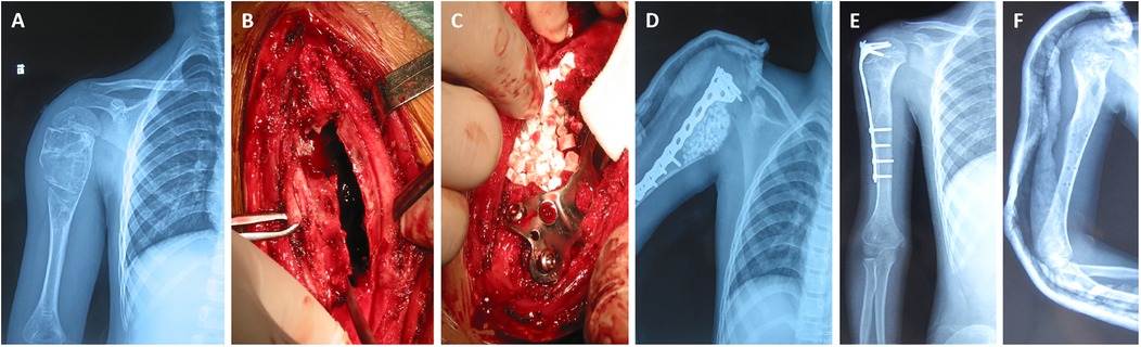 Panel A shows an X-ray of a shoulder and upper arm before surgery, with a visible fracture. Panel B captures an open surgical site exposing the bone. Panel C shows surgical placement of a metal plate and bone graft. Panel D presents an X-ray post-surgery with the plate and graft in place. Panel E reveals another X-ray with additional screws securing the site. Panel F provides an X-ray view from a different angle, emphasizing the alignment and fixation.