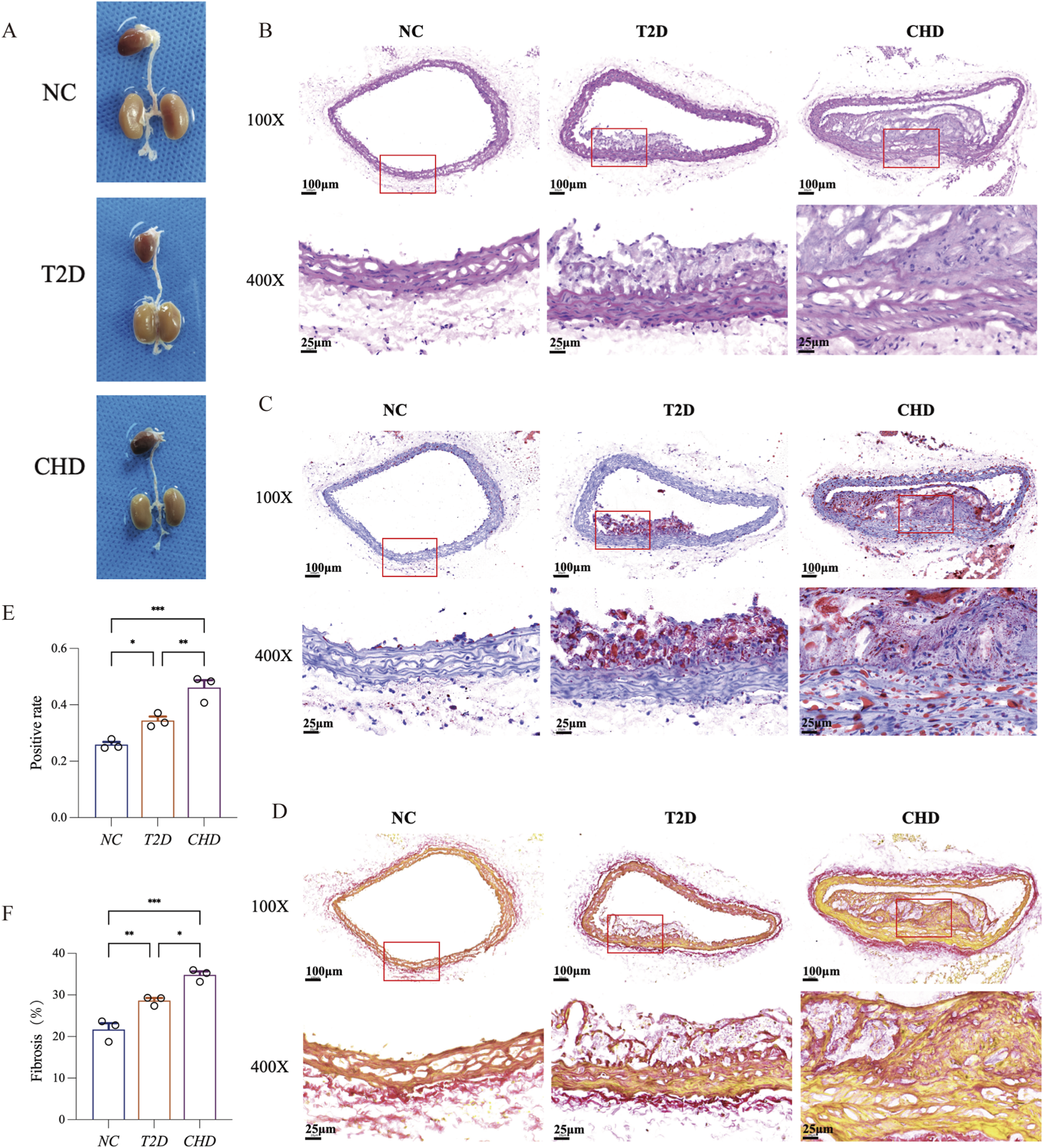 Panel A shows three clusters of beans labeled NC, T2D, and CHD. Panels B, C, and D display histological artery cross-sections at magnifications of 100X and 400X for NC, T2D, and CHD, highlighting differences in tissue structure. Panels E and F present bar graphs comparing positive rate and fibrosis percentage among NC, T2D, and CHD, showing statistical significance.