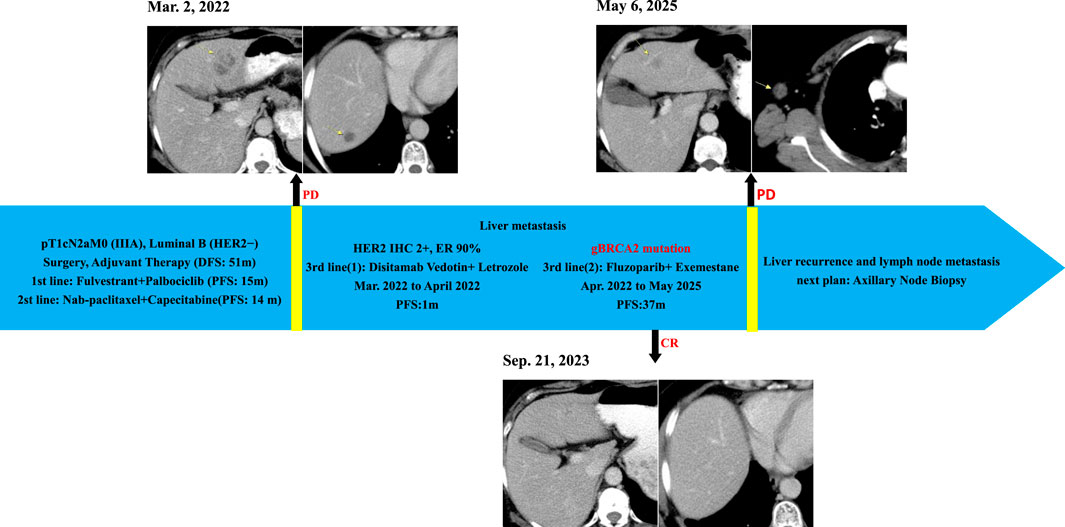 Timeline of medical imaging showing cancer progression and treatments. Top-left, images from March 2, 2022, show initial tumor. Top-right, May 6, 2025, indicates progression. Bottom images, September 21, 2023, display further changes. Blue arrow highlights treatment timeline with text detailing cancer type, treatments, and duration. Mentioned interventions include Fulvestrant, Palbociclib, Nab-paclitaxel, Capecitabine, Disitamab Vedotin, Letrozole, Fluzoparib, and Exemestane. Notes indicate disease progression (PD) and complete response (CR). Upcoming plan outlines axillary node biopsy.