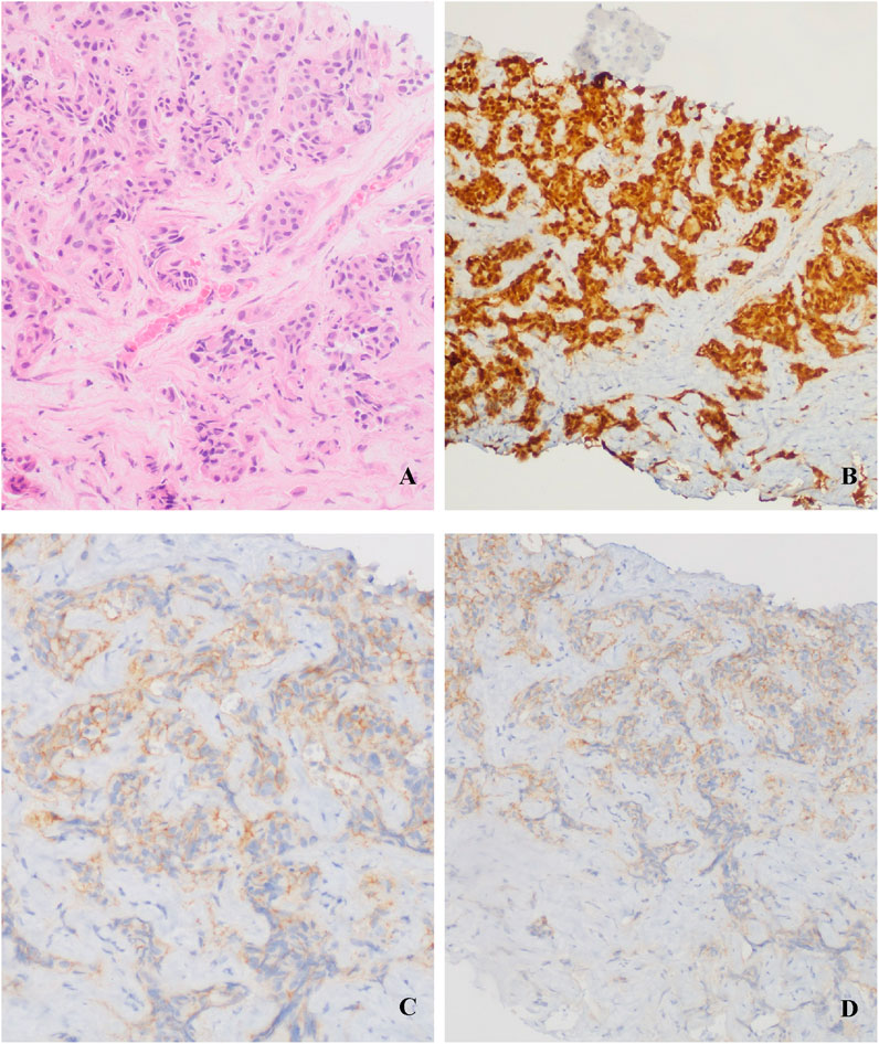 Histological images of tissue samples labeled A, B, C, and D. A shows pink tissue with dense, irregular cell patterns. B displays brown-stained areas indicating protein presence. C and D have lighter staining compared to B, showing different densities and distributions.