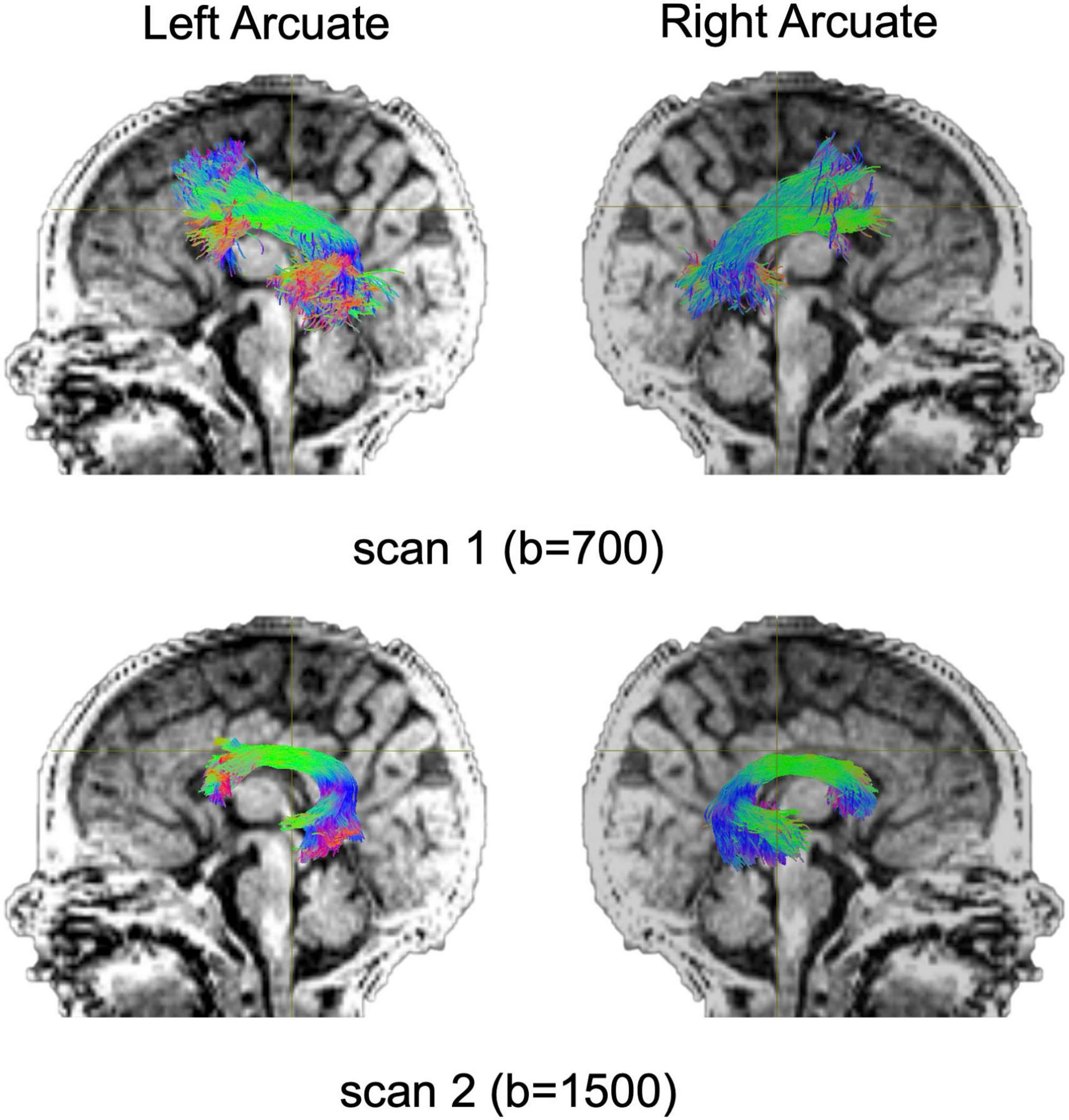 Image depicts left and right arcuate fasciculus displayed on T1-weighted MRI scan. Tract coloring depicts directionality. Top row displays left and right arcuate obtained from scan 1 with b-value of 700. Bottom row displays left and right arcuate obtained from scan 2 with b-value of 1500.