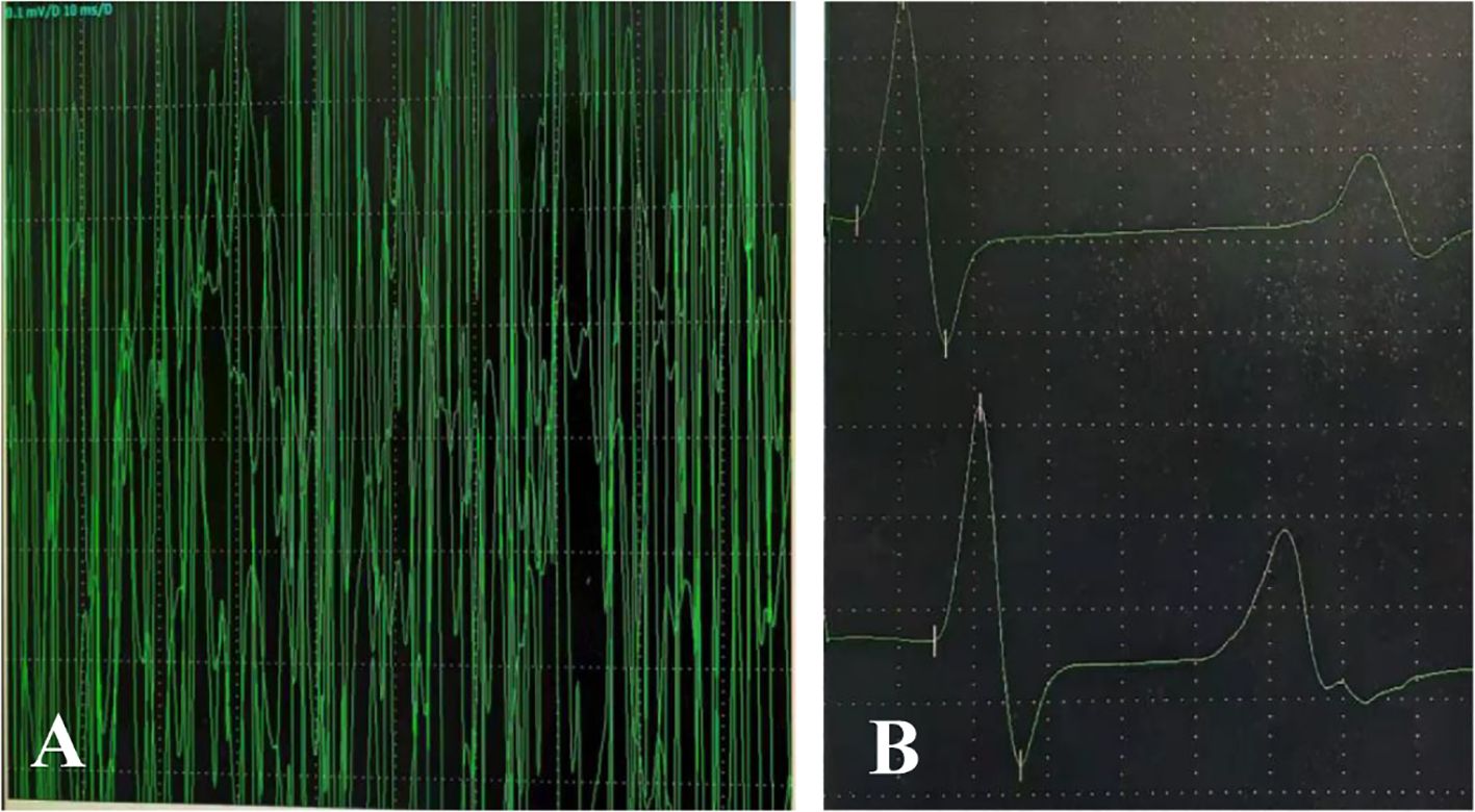 Panel A shows a dense, chaotic display of oscillating green lines on a dark background, indicating high-frequency noise or interference. Panel B presents fewer, clear waveform patterns, suggesting more organized data or signals.