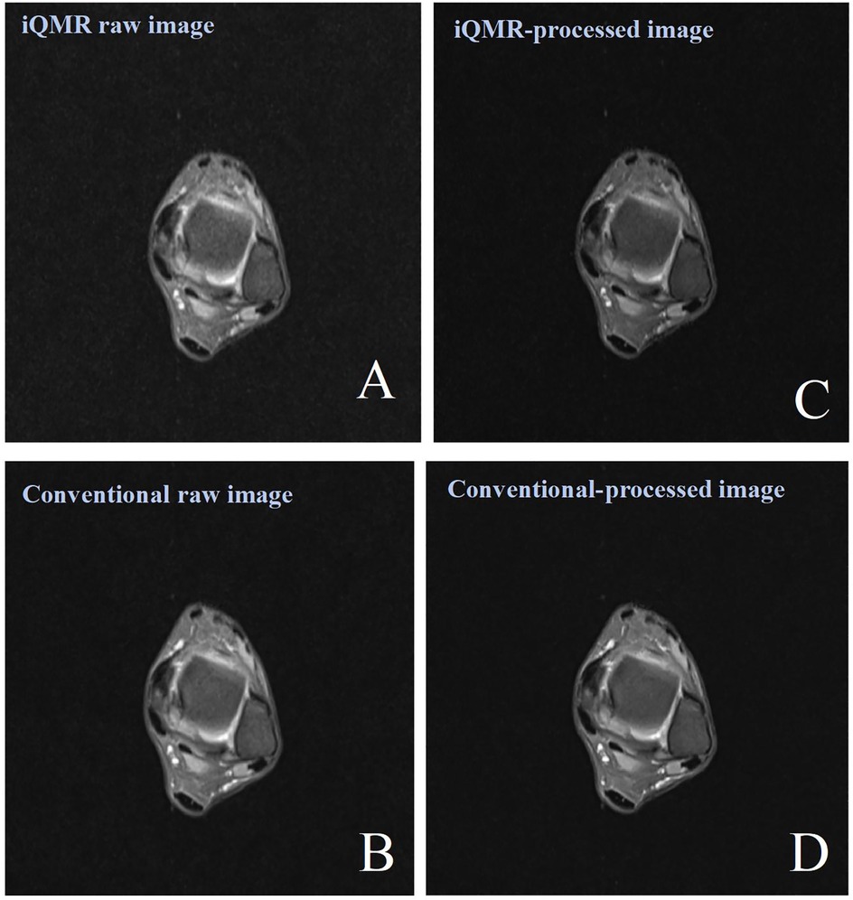 Four MRI images in a 2x2 grid show variations in raw and processed formats. Top left (A) is an iQMR raw image; top right (C) is an iQMR-processed image. Bottom left (B) is a conventional raw image; bottom right (D) is a conventional-processed image. Each image illustrates different processing outcomes.