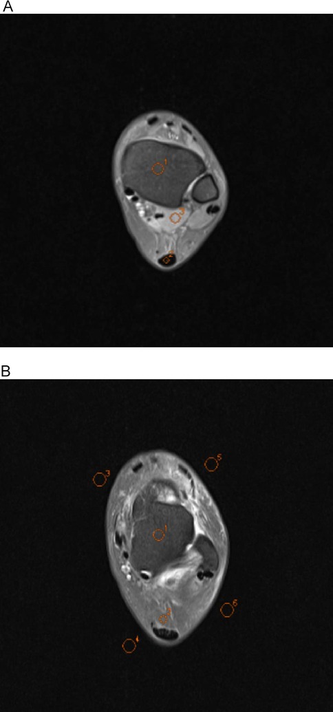 MRI scans of a cross-section of a limb, labeled A and B. In both images, various circular areas are highlighted with orange dotted lines, each numbered. The scans depict different tissue densities within the limb.