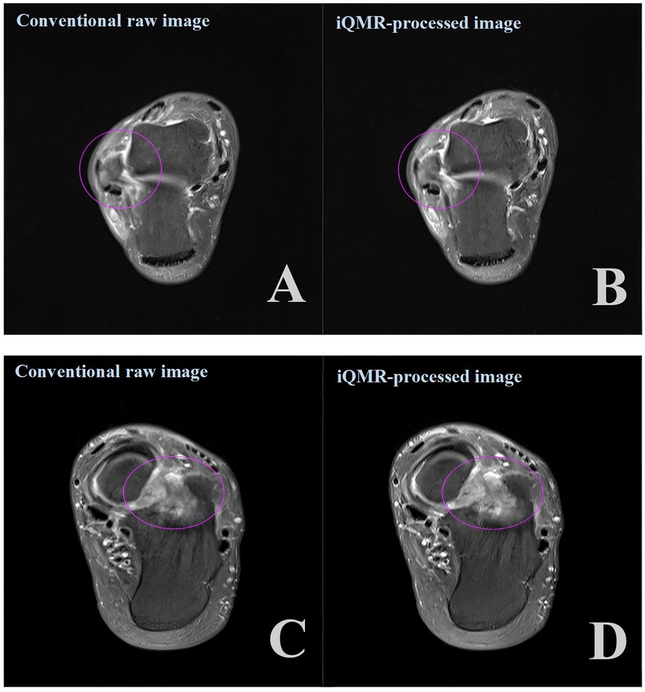 Side-by-side comparison of MRI images. The top row shows a conventional raw image (A) and its iQMR-processed counterpart (B) with a purple circled area. The bottom row repeats this format, with the raw image (C) and the processed image (D) also displaying a purple circled area. Both processed images appear sharper than their raw counterparts.