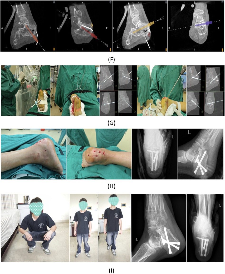 Composite figure showing stages of surgical management of a calcaneal fracture. Panel A presents 3D CT and axial/sagittal CT images of the fractured calcaneus. Panel B shows patient positioning and foot stabilization with straps and fixation devices. Panel C illustrates intraoperative imaging setup with a C-arm fluoroscope and associated equipment. Panel D demonstrates intraoperative imaging, surgical steps including guidewire placement, screw insertion, and use of fluoroscopy for positioning. Panel E shows final fixation with hardware in place, confirmed by intraoperative CT imaging. Composite figure illustrating intraoperative and postoperative stages of calcaneal fracture fixation. Panel F shows intraoperative CT scans with guidewire and screw trajectory planning. Panel G depicts surgical steps with guidewire insertion under imaging guidance and confirmation of alignment. Panel H displays immediate postoperative images, including sutured incisions on the heel and lateral/axial X-rays showing fixation with multiple screws. Panel I presents clinical follow-up, with the patient performing squatting and walking, alongside radiographs confirming maintained screw fixation and bone alignment.