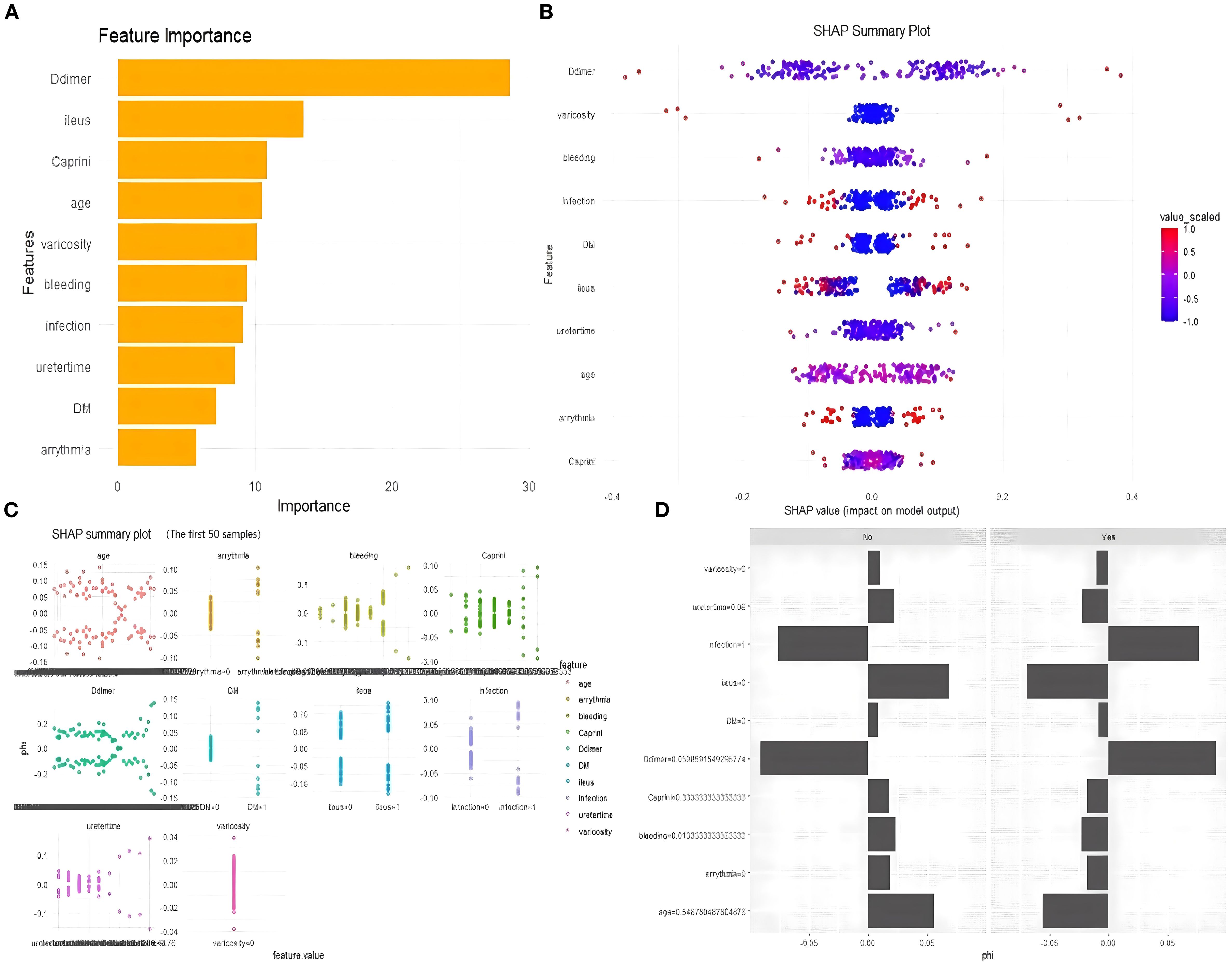 Panel A displays a bar chart of feature importance, highlighting “D-dimer” as the most significant feature. Panel B is a SHAP summary plot illustrating the impact of various features on model output, with a color scale indicating scaled values. Panel C presents SHAP summary plots for the first fifty samples across different features like age and arrhythmia, showing their distribution and impact. Panel D consists of mirrored bar charts comparing the phi values for the presence (