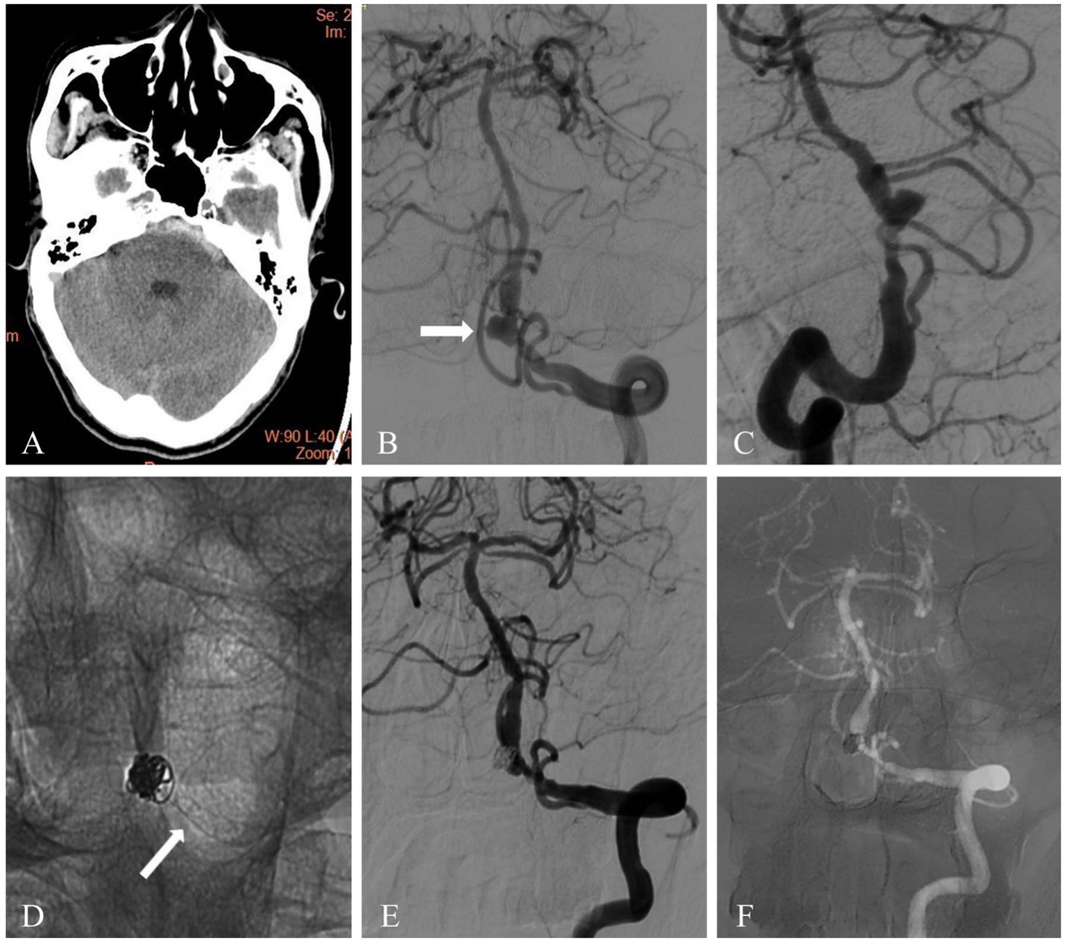 A composite image with six panels showing brain imaging and angiography. Panel A depicts a CT scan of the brain. Panels B and E display angiographic images of cerebral arteries with aneurysms. Panel C shows blood vessels without visible abnormalities. Panel D focuses on a coiled aneurysm with an arrow pointing to it. Panel F shows a post-treatment angiographic image with the contrast material highlighting vessels. Each panel provides a different perspective on cerebral vasculature and aneurysm management.