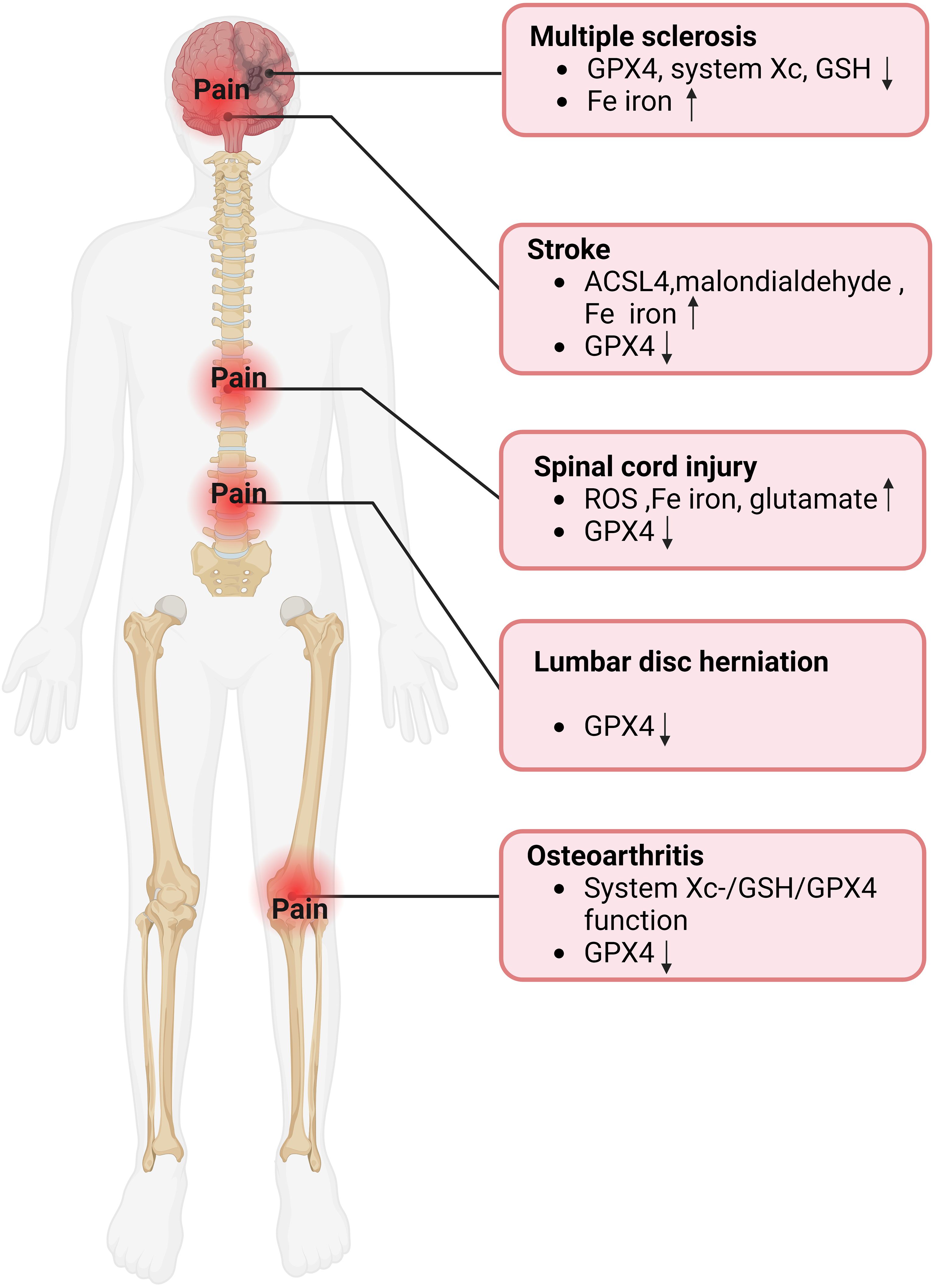 Diagram of a human body highlighting areas of pain associated with various conditions. For multiple sclerosis, pain in the brain; stroke, spinal pain; spinal cord injury, middle back pain; lumbar disc herniation, lower back pain; osteoarthritis, knee pain. Annotations include changes in biomarkers like GPX4, Fe iron, and ROS.