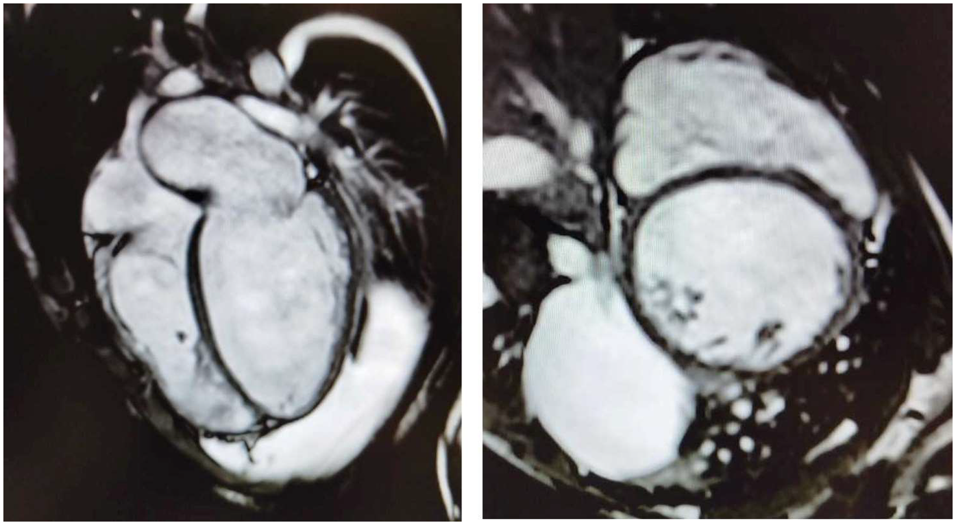 Two MRI scans of the heart are displayed. The left image shows a detailed view of the heart's chambers and valves, while the right image depicts another angle emphasizing the heart's rounded structure. Both images have shades of black, white, and gray.