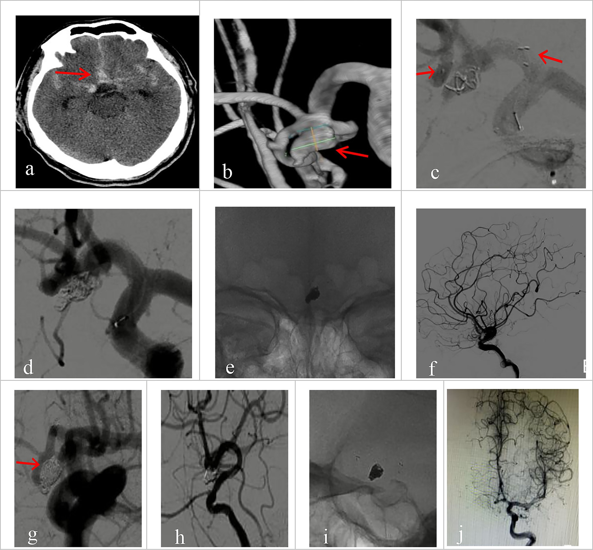 Panel of ten medical images showing various views and scans of cerebral vessels and brain structures. Each image features arrows pointing to specific areas of interest, highlighting abnormalities or treatment sites, such as aneurysms or coiling. The images vary from black-and-white to grayscale, reflecting different imaging techniques like CT scans and angiography.