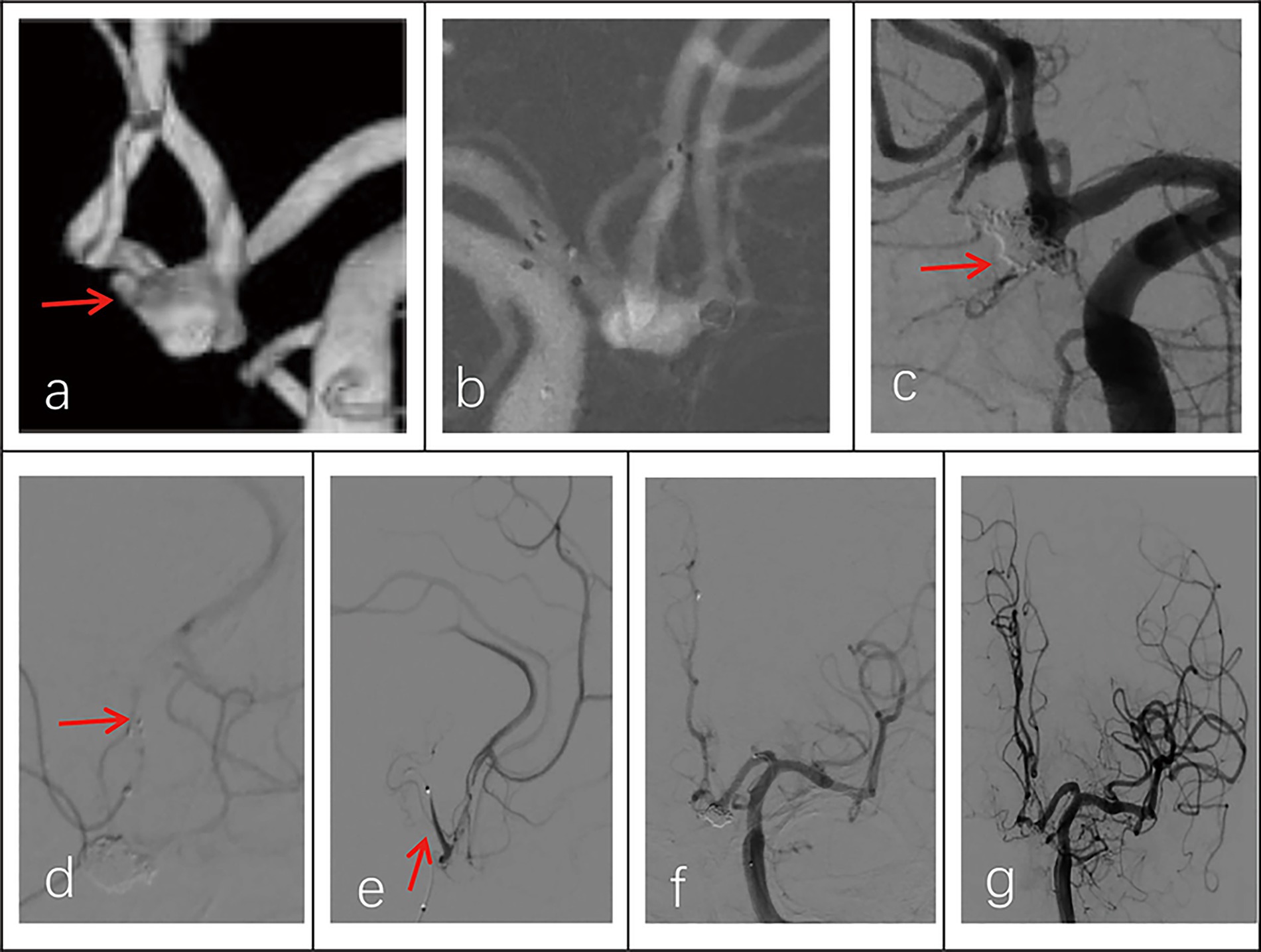 Six-panel medical imaging series labeled a to g, showing vascular structures. Panel a shows a highlighted area with an arrow pointing to a bulge. Panel b has a view of blood vessels without arrows. Panel c features an arrow indicating a certain region. Panels d and e show arrows pointing to parts of the vascular system. Panel f displays vessels without markers, and panel g shows a more intricate vascular network. Each panel focuses on different aspects of vascular imaging.