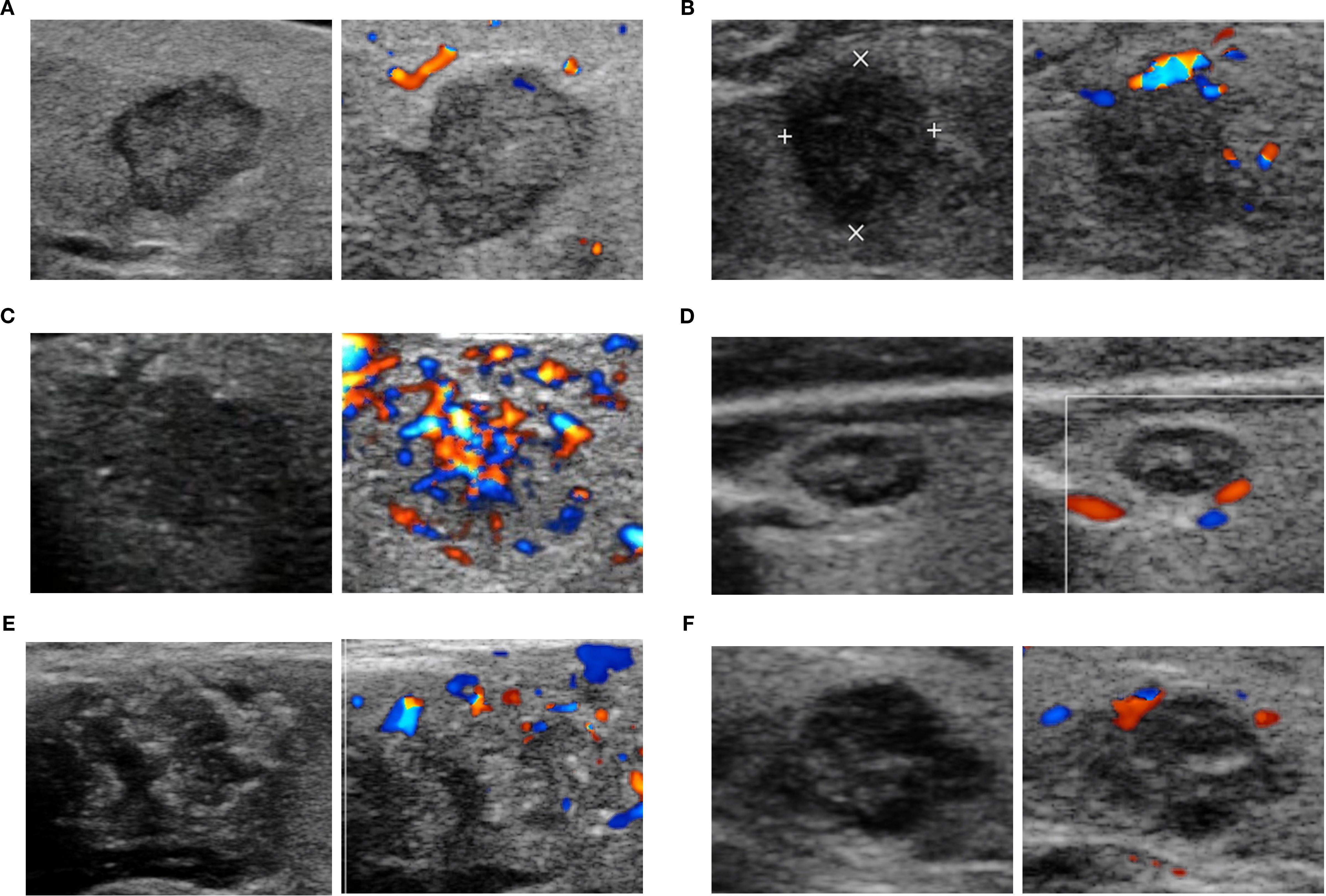 Ultrasound images in six panels labeled A to F, each showing grayscale scans with color Doppler imaging to indicate blood flow. Panel A shows a structure with blue and red areas above it. Panel B features a dark circular region with cross markers and adjacent color Doppler. Panel C shows a darker area with extensive blue and red speckles. Panel D displays a round structure with minimal color Doppler. Panel E reveals a swirled pattern with surrounding color Doppler. Panel F presents a dark, rounded area, partially surrounded by blue and red Doppler signals.