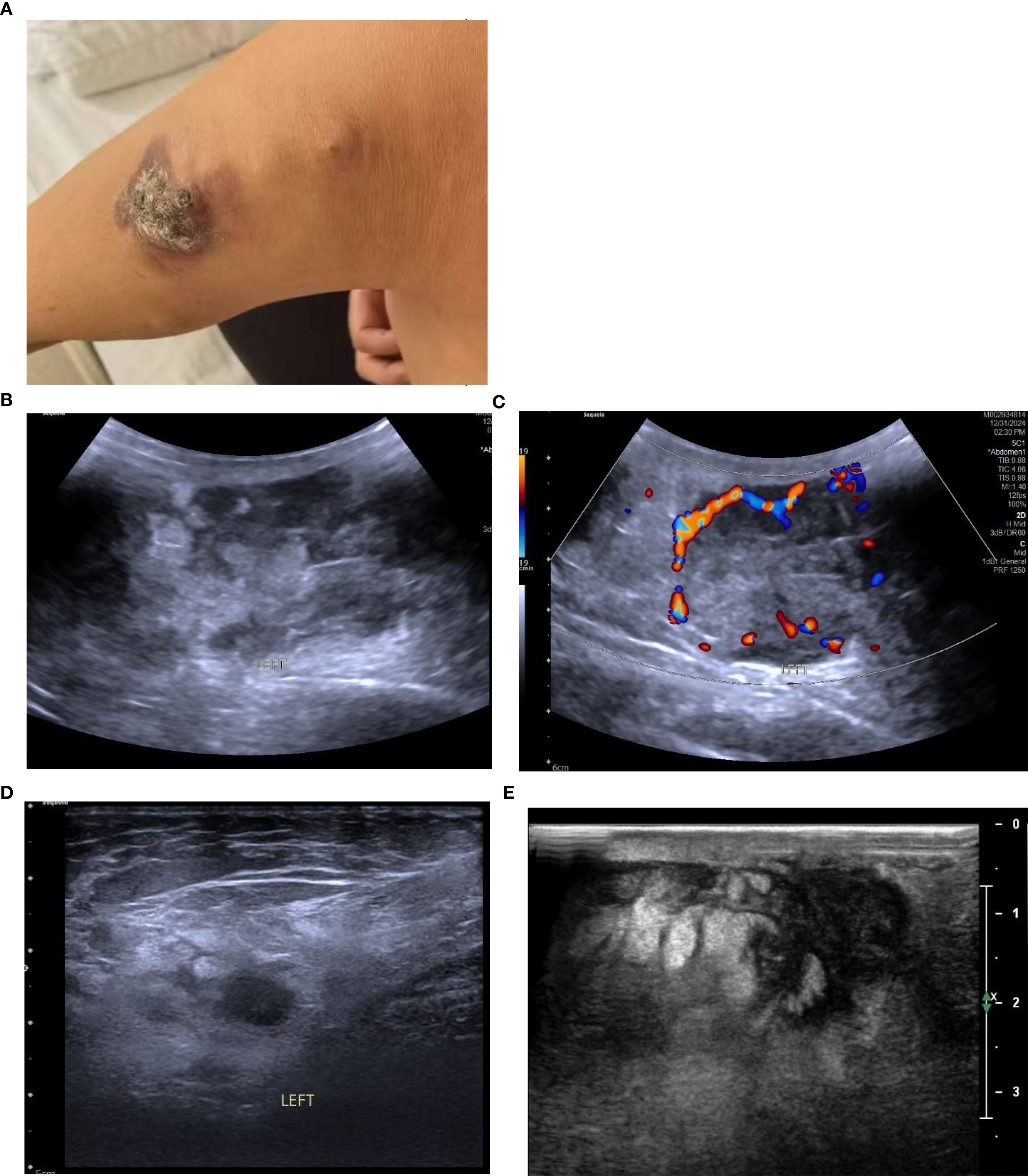 A. Close-up of a skin lesion on an arm, showing a scabbed and discolored area. B. Ultrasound image labeled “LEFT,” showing internal tissue structures with varying shades of gray. C. Ultrasound with color Doppler, displaying blood flow in red and blue within the image. D. Another ultrasound labeled “LEFT,” depicting internal tissue structures. E. Ultrasound showing layered tissue structures and varying gray shades.