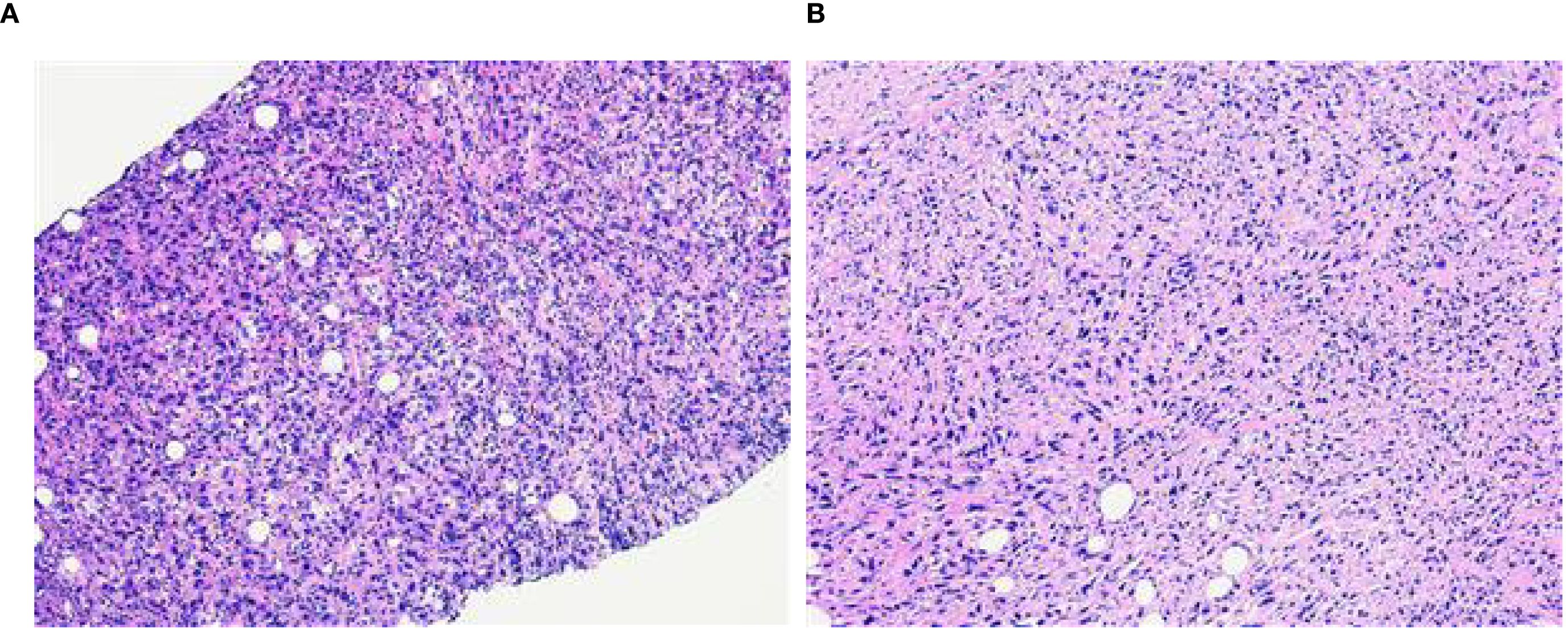 Panel A shows a histological section with dense clusters of small, round cells, likely indicating a packed tissue sample. Panel B illustrates a more fibrous arrangement, with elongated cells and fewer clusters, possibly showing connective tissue. Both sections are stained in shades of purple and pink.