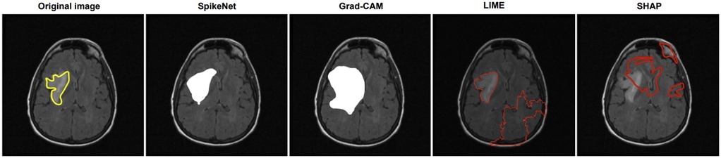 Five-panel comparison of brain MRI interpretations. The original image highlights a region in yellow. SpikeNet and Grad-CAM show white areas indicating focus regions. LIME and SHAP depict areas outlined in red, differing in size and shape.