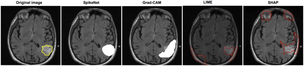 Comparison of brain MRI interpretations using different techniques. The first image shows the original MRI with a yellow outline. The second, third, fourth, and fifth images show the same MRI analyzed by SpikeNet, Grad-CAM, LIME, and SHAP, respectively, with highlighted areas in white or red indicating regions of interest.