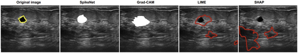 Five ultrasound images of the same area, each demonstrating different image processing techniques. The original image highlights a section in yellow. The SpikeNet image displays a white highlighted region. Grad-CAM shows a different white highlighted area. LIME outlines in red around two regions. SHAP highlights multiple red-bordered areas, varying in size and shape.