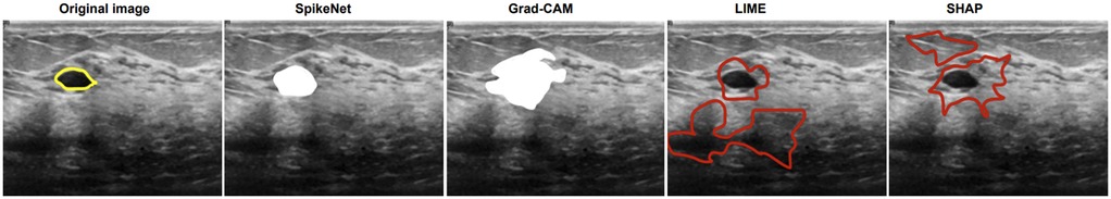 Five ultrasound images compare different segmentation methods. The original image highlights a region in yellow. SpikeNet and Grad-CAM emphasize a white area. LIME and SHAP use red outlines to indicate regions of interest.
