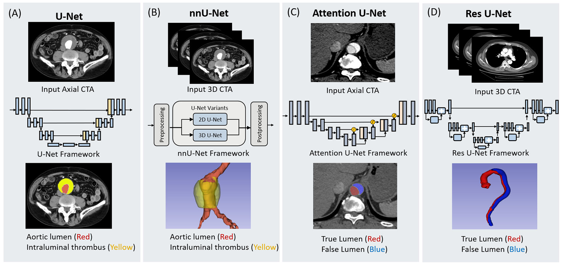 Comparison of four U-Net frameworks in medical imaging for aortic analysis. (A) U-Net processes axial CTA to highlight the aortic lumen in red and intraluminal thrombus in yellow. (B) nnU-Net handles 3D CTA, distinguishes the aortic lumen in red and thrombus in yellow using a preprocessing and postprocessing workflow. (C) Attention U-Net takes axial CTA, focusing on true lumen in red and false lumen in blue with an attention mechanism. (D) Res U-Net uses 3D CTA, identifying true lumen in red and false lumen in blue through a residual learning framework.