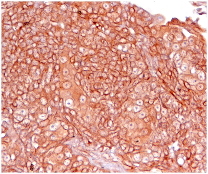 Microscopic image showing a dense cluster of brown stained cells with membranous and cytoplasmic labeling, with distinct nuclei, typical of a histological tissue section. The cells appear irregularly shaped and closely packed, suggesting a pathological analysis.