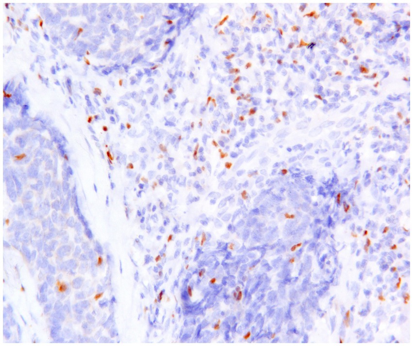 Microscopic image showing clusters of cells with varying densities in shades of blue and purple. Numerous small, circular areas are stained reddish-brown, indicating specific cell components. The texture is uneven, with lighter and darker regions.