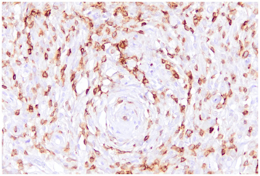 Microscopic view of tissue stained to highlight cell structures. Brown-tinted cells form circular patterns against a lighter background, indicating variations in cell composition and density. Membranous brown labeling of some cells.