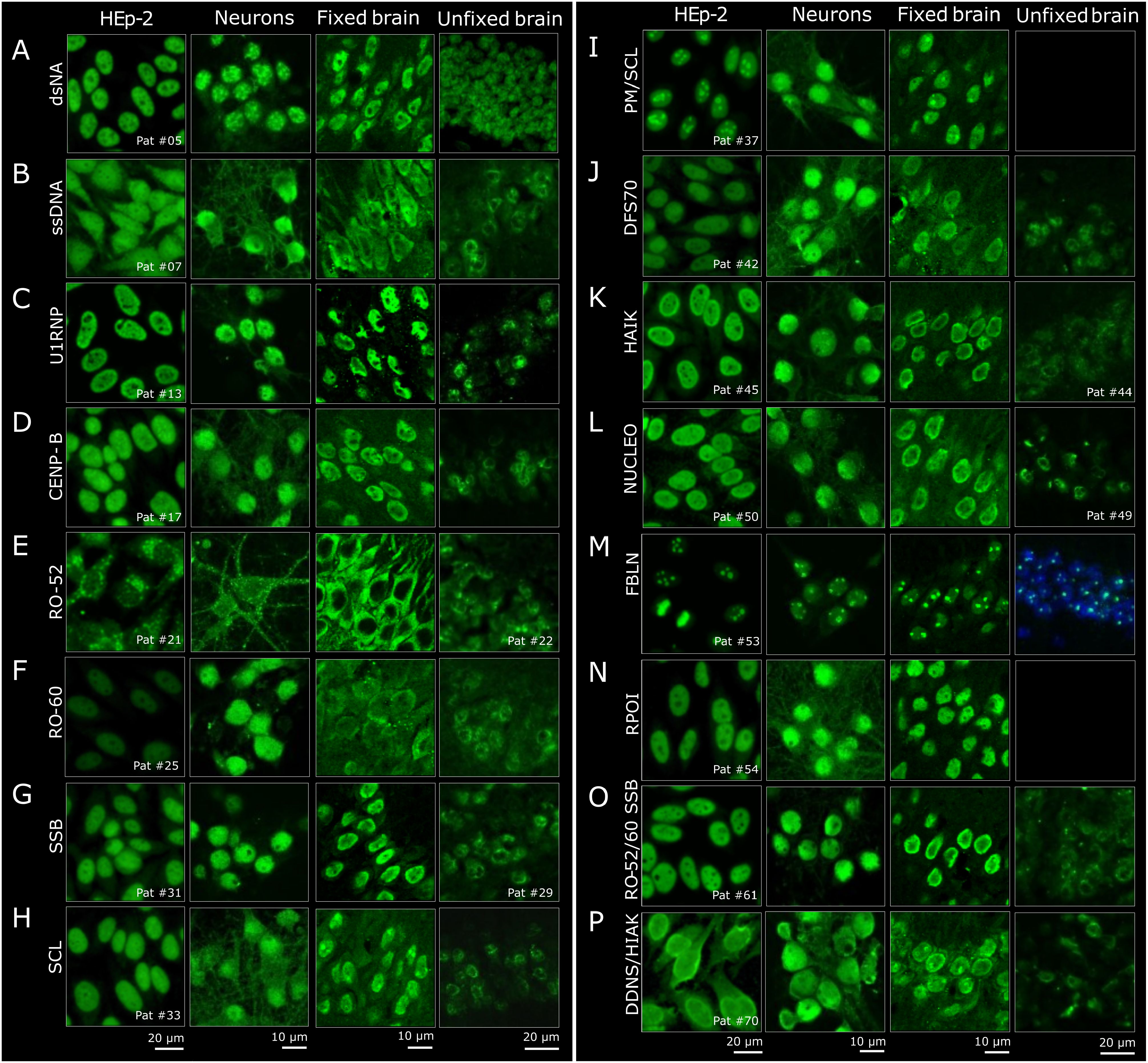 Fluorescent microscopy panels displaying various green-stained cellular structures from HEp-2 cells, neurons, and fixed and unfixed brain tissues. Each row, labeled A to P, showcases different patient samples with specific protein markers, such as dsDNA and Ro-52, across four columns. Some panels, like panel M, show additional blue staining. The scale bar varies per row, indicating different magnifications.