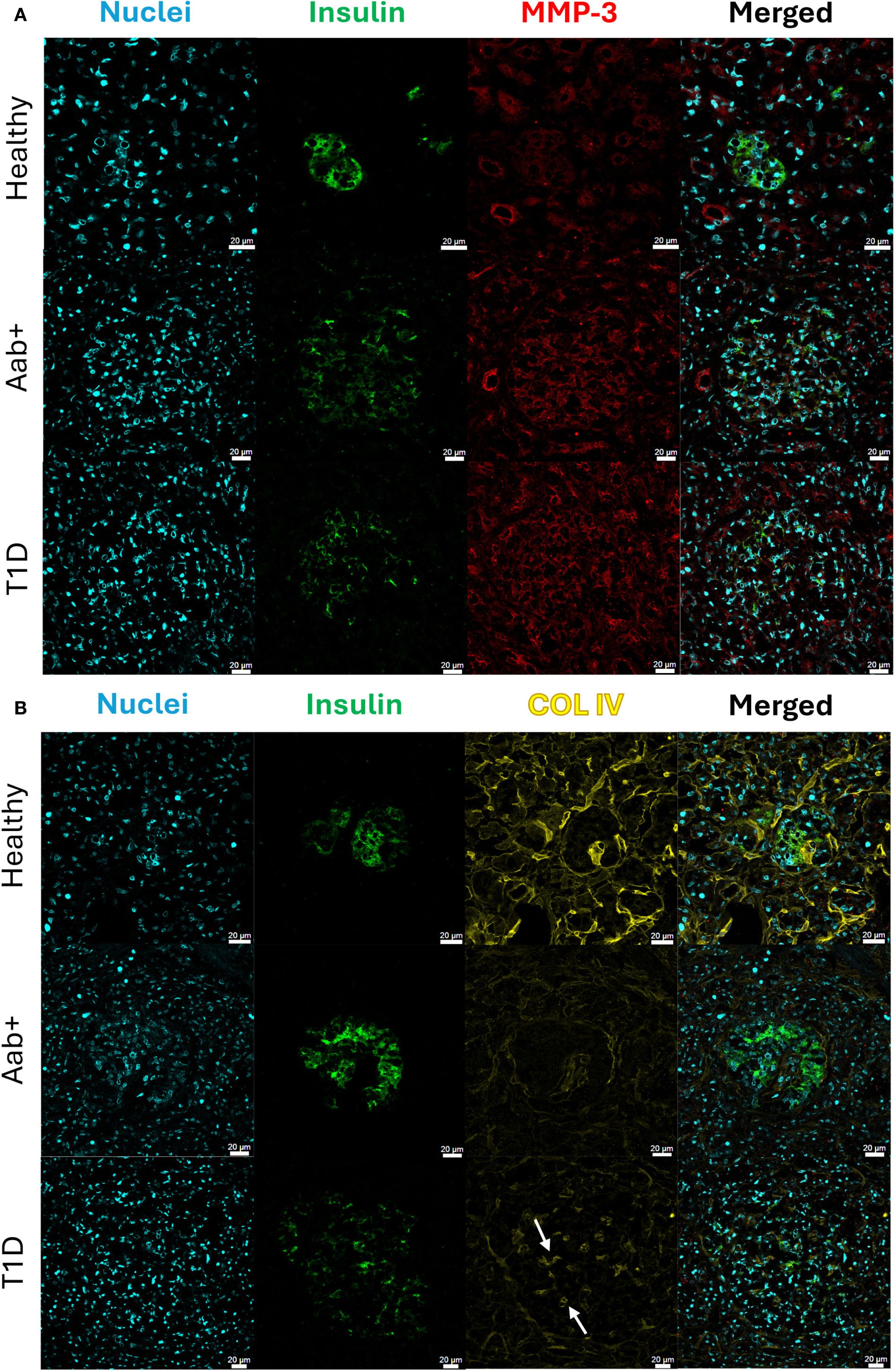 Two panels labeled A and B show immunofluorescence images of pancreatic tissue sections. Panel A includes columns for Nuclei in blue, Insulin in green, and MMP-3 in red, with a merged image. Panel B includes columns for Nuclei in blue, Insulin in green, and COL IV in yellow, with a merged image. Rows show sections from Healthy, Aab+, and T1D samples. Scale bars are 20 micrometers.
