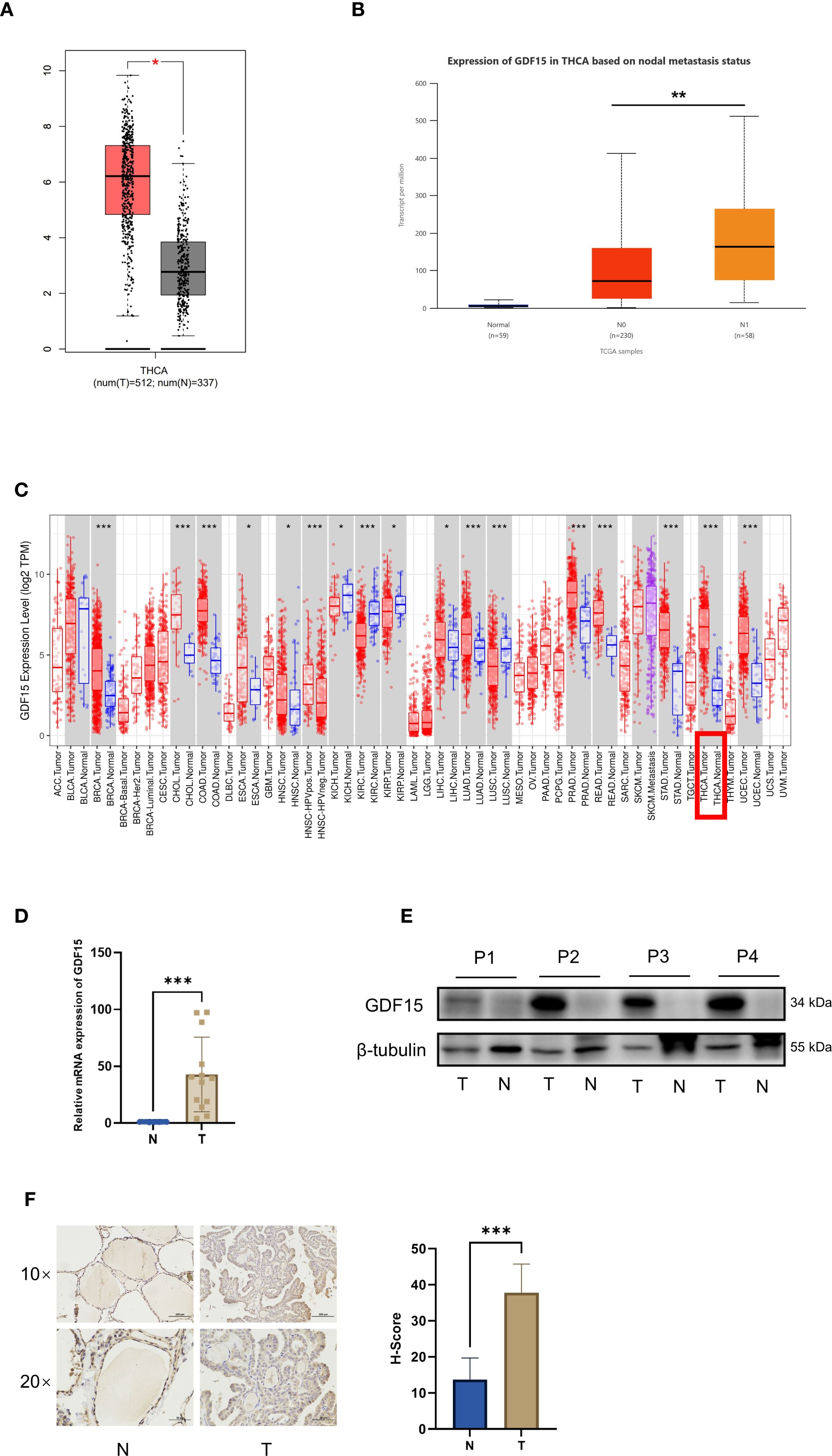 Panel A shows a box plot comparing GDF15 expression levels in thyroid cancer (THCA) versus normal tissues, with higher expression in THCA. Panel B displays a box plot of GDF15 expression in THCA based on nodal metastasis status, showing higher levels in metastatic samples. Panel C presents multiple box plots of GDF15 expression across various tumors, highlighting significant differences. Panel D indicates a bar chart comparing mRNA expression levels of GDF15 in normal and tumor tissues, with higher expression in tumors. Panel E shows a Western blot analysis of GDF15 protein levels in patient samples, with higher expression in tumor tissues. Panel F presents immunohistochemistry images comparing normal and tumor tissues, accompanied by an H-score bar chart, indicating stronger staining in tumor tissues.