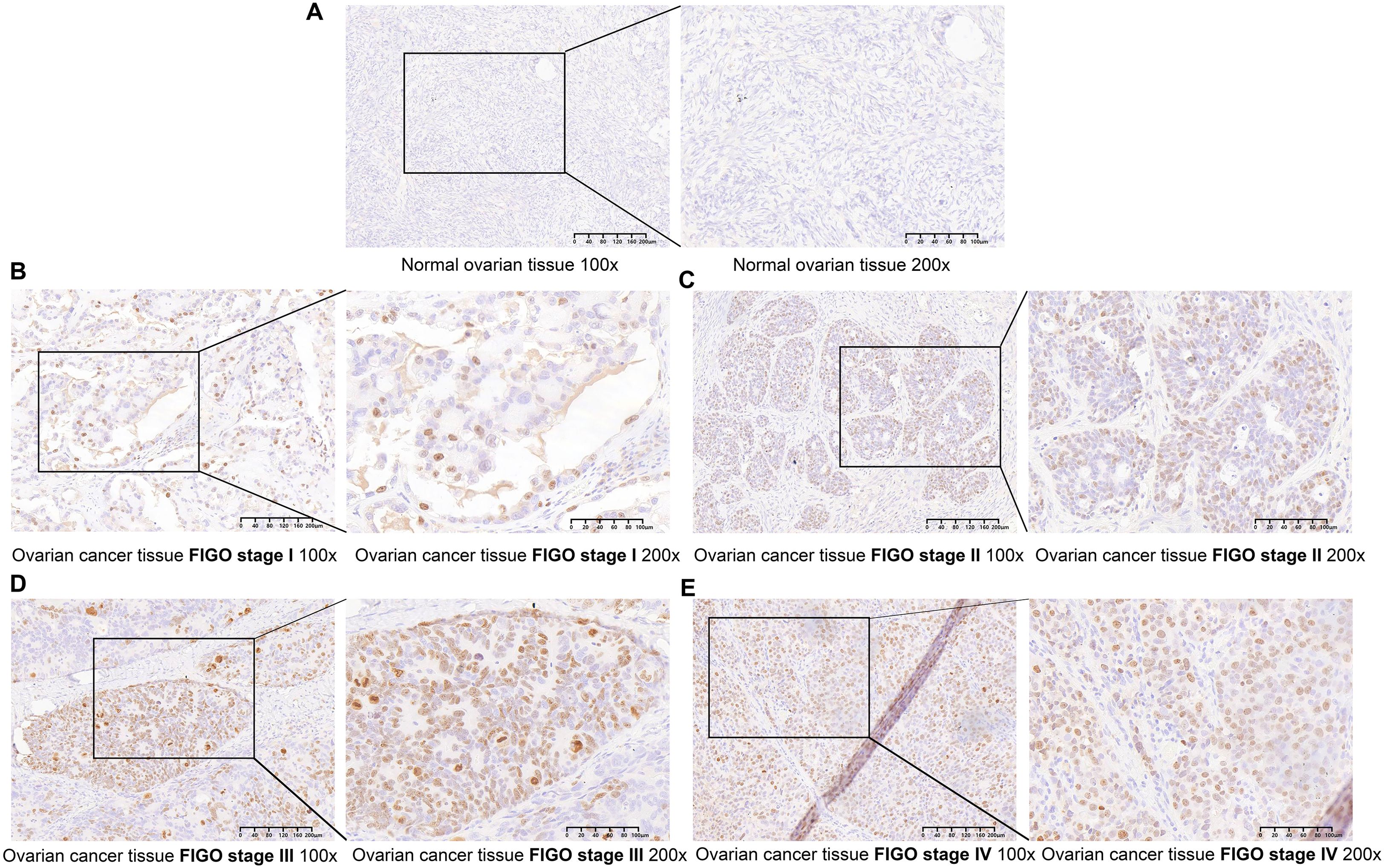 Five histology panels displaying ovarian tissue samples at different magnifications and FIGO cancer stages. Panel A shows normal ovarian tissue at one hundred times and two hundred times magnification. Panels B to E display ovarian cancer tissues at FIGO stages one to four, each at one hundred times and two hundred times magnification. Each panel includes a box highlighting areas of interest for detailed examination, revealing variations in cellular structure and staining patterns consistent with cancer progression.