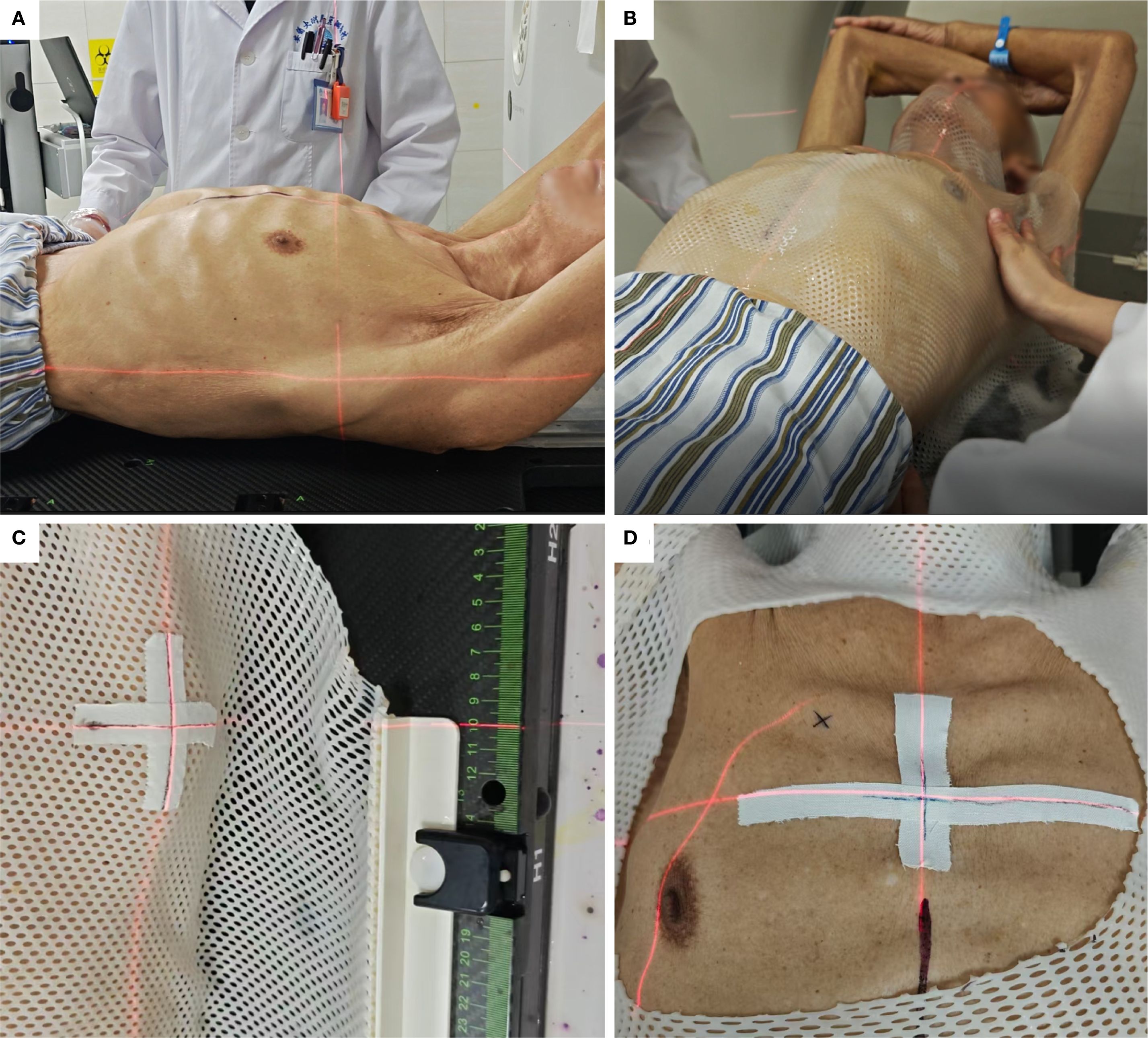 Medical procedure setup showing a person undergoing radiation therapy. Panel A displays a patient lying on their side, marked with laser guides. Panel B shows a patient covered with a mesh immobilization mask. Panel C focuses on a section of the mask with a marked cross. Panel D highlights the patient's chest, marked with tape and laser lines for accurate targeting.
