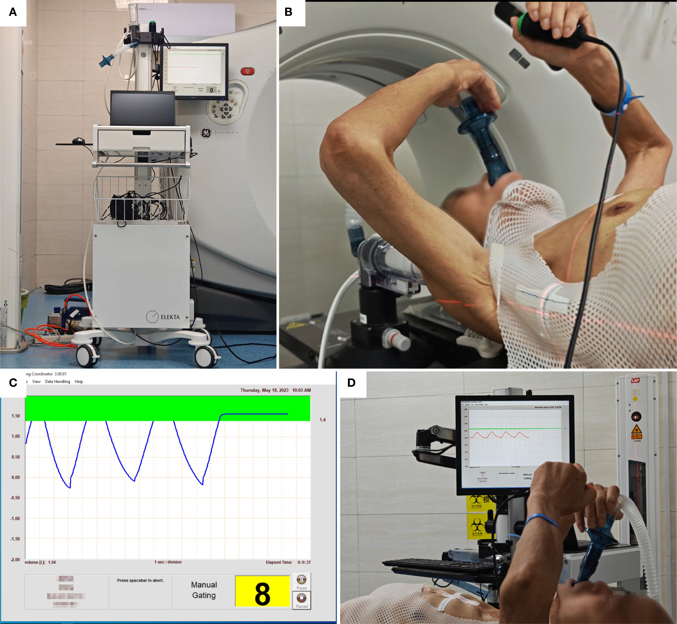 A medical equipment setup with four images: A) A machine marked Elekta with a monitor and various cables. B) A person lying in a CT scanner holding a breathing device. C) A graphical display of a breathing cycle, showing peaks and a manual gating button labeled '8'. D) A person using a breathing device while another monitor shows a graph.