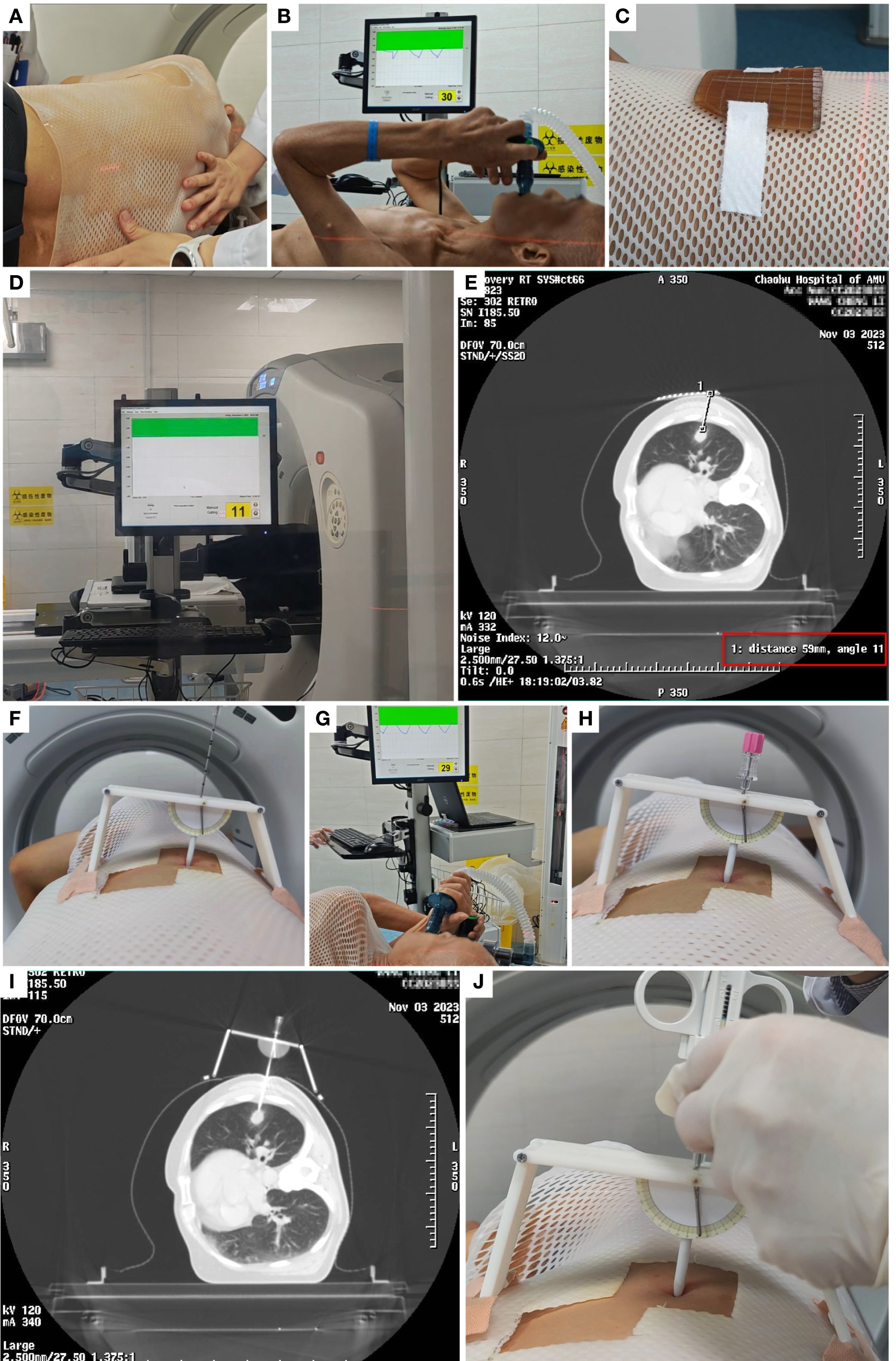 A sequence of images related to a medical procedure. Image A shows a person covered with a mesh material. Image B captures the same person using a breathing device while a monitor displays data. Image C focuses on a close-up of the mesh with adhesive strips attached. Image D depicts medical equipment with a visible screen. Image E shows a CT scan of a torso with a labeled measurement. Image F presents a person with the mesh and a frame, indicating precision alignment. Image G shows a seated person interacting with equipment. Image H is a close-up of a needle inserted through the mesh. Image I displays a CT scan with the needle in place. Image J shows a gloved hand using a syringe through the mesh.