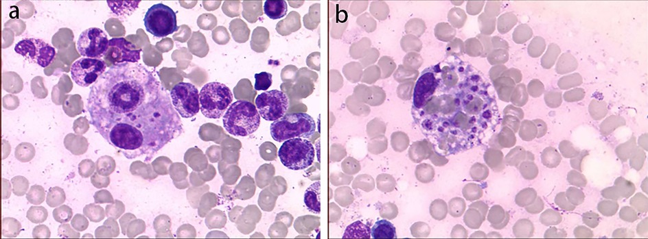 Microscopic view of blood cells showcasing abnormal cells with large, dark purple nuclei among smaller, lighter-stained red blood cells. The left panel features more dense clusters, while the right panel shows a larger, singular abnormal cell.
