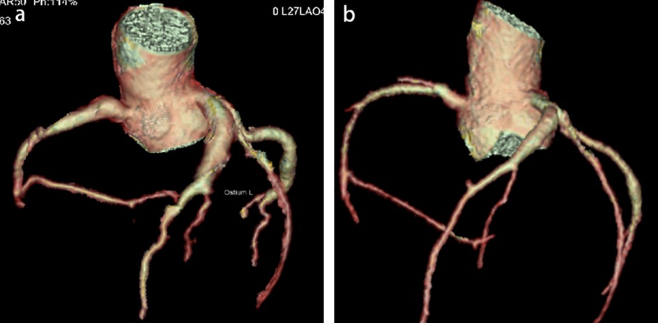 CT angiography images showing a three-dimensional reconstruction of the coronary arteries. The left panel includes the left coronary artery clearly marked with \