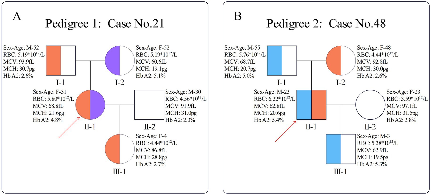 Two pedigree charts labeled A and B show genealogical data with associated hematological parameters. A: Case No. 21 shows individuals with circles and squares, indicating sex and age, connected by lines. It includes specifics like RBC, MCV, MCH, and Hb A2 percentages. B: Case No. 48 follows a similar format with different data for each member. Highlighted portions of shapes indicate genetic traits, with arrows pointing to specific individuals in both pedigrees.