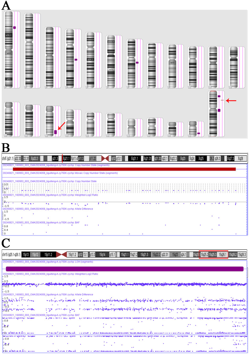 Panel A displays a karyotype with highlighted regions on chromosomes 2 and X. Panel B presents genomic data for chromosome X, showing copy number variations and mosaicism. Panel C illustrates genomic data for chromosome 15, emphasizing regions 15q25.2 and 15q26.1 with allelic differences and segments of loss of heterozygosity (LOH).