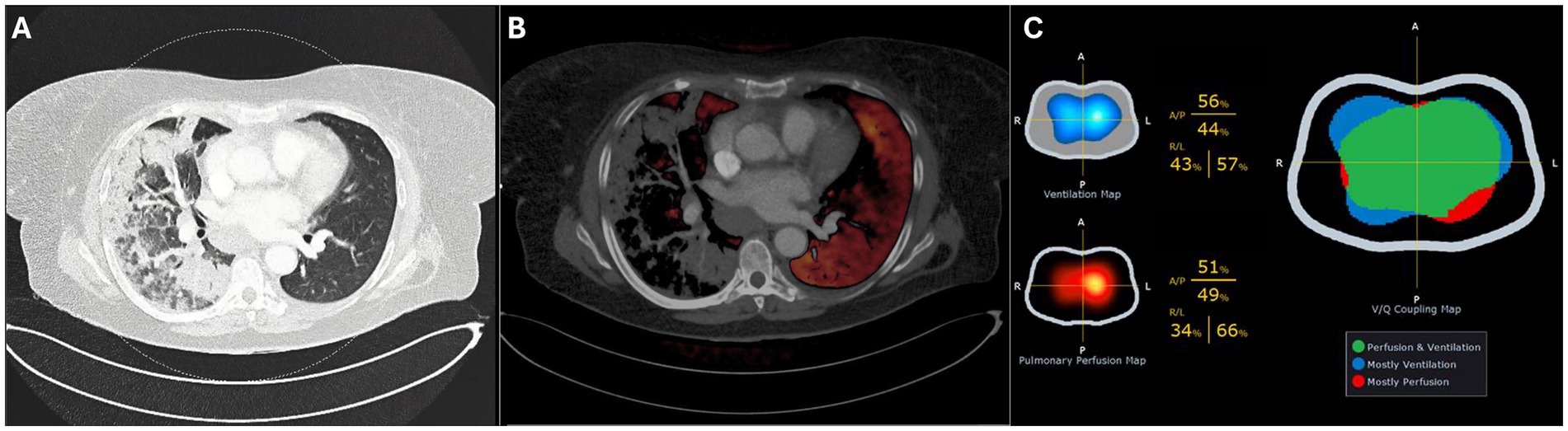 CT scan and imaging analysis of the chest in a three-part image. Panel A shows a grayscale CT scan with visible lung structures. Panel B highlights red and black-marked regions indicating perfusion. Panel C displays maps for ventilation, pulmonary perfusion, and V/Q coupling, with color-coded areas and percentages for each map.
